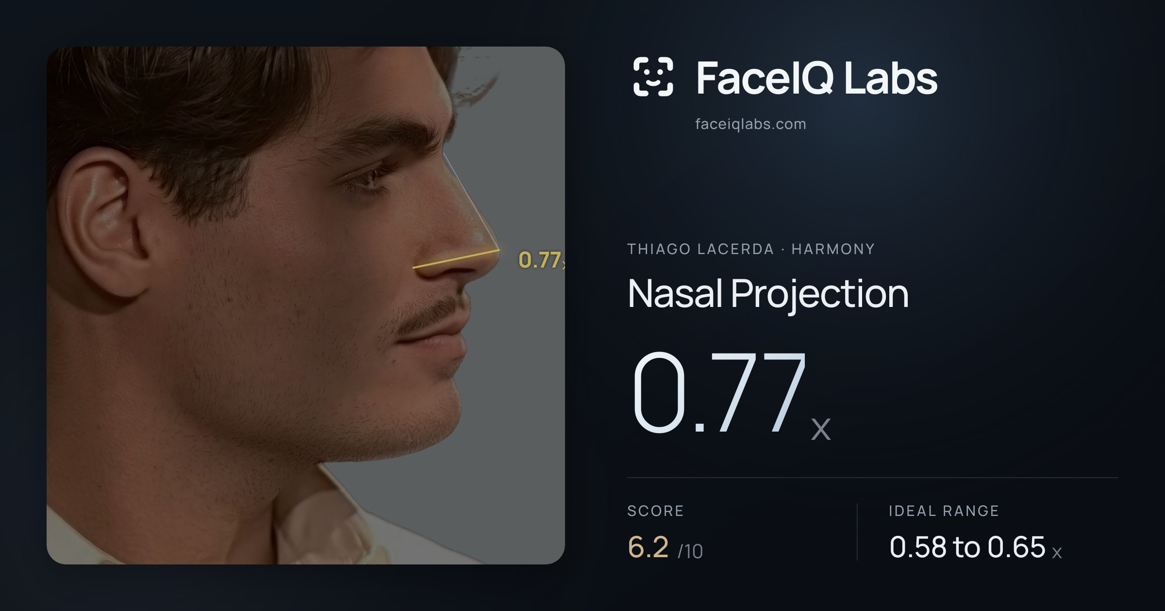 Thiago Lacerda Nasal Projection: 0.77x, drawn on the photo