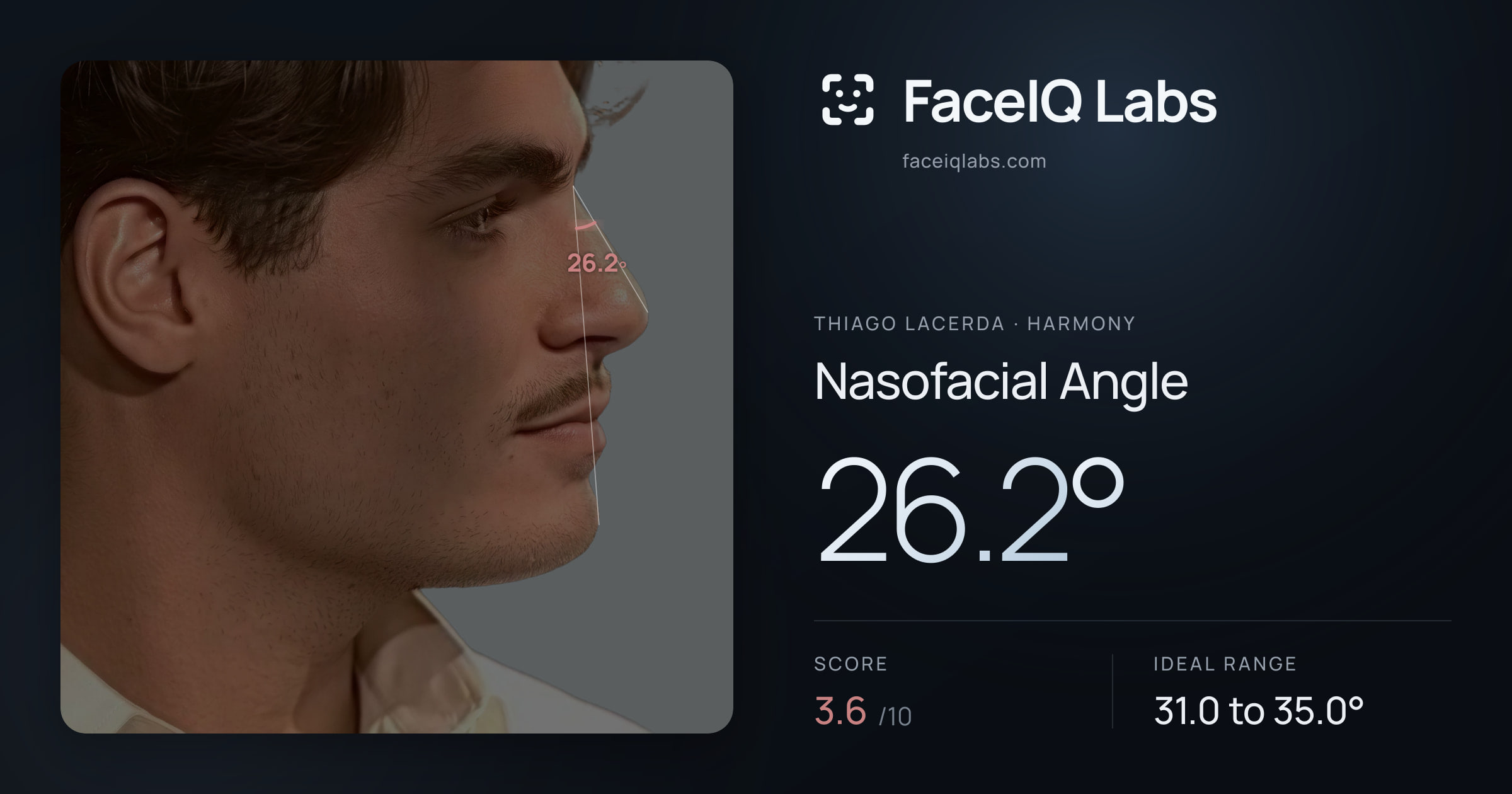 Thiago Lacerda Nasofacial Angle: 26.2°, drawn on the photo