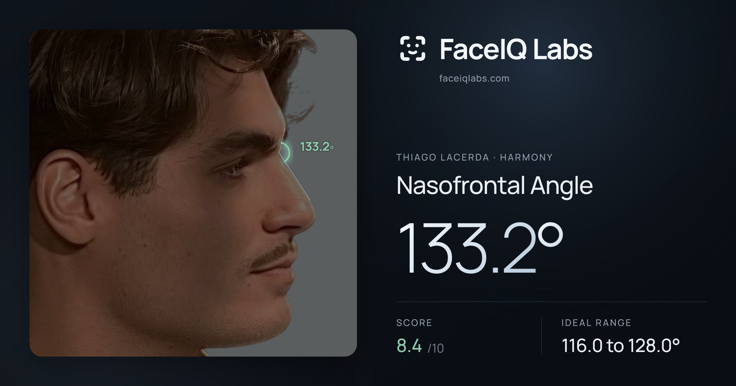 Thiago Lacerda Nasofrontal Angle: 133.2°, drawn on the photo