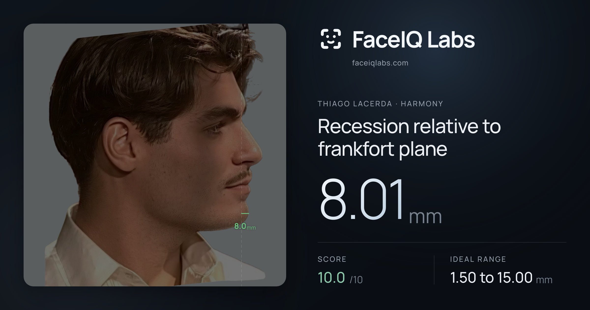 Thiago Lacerda Recession relative to frankfort plane: 8.01mm, drawn on the photo