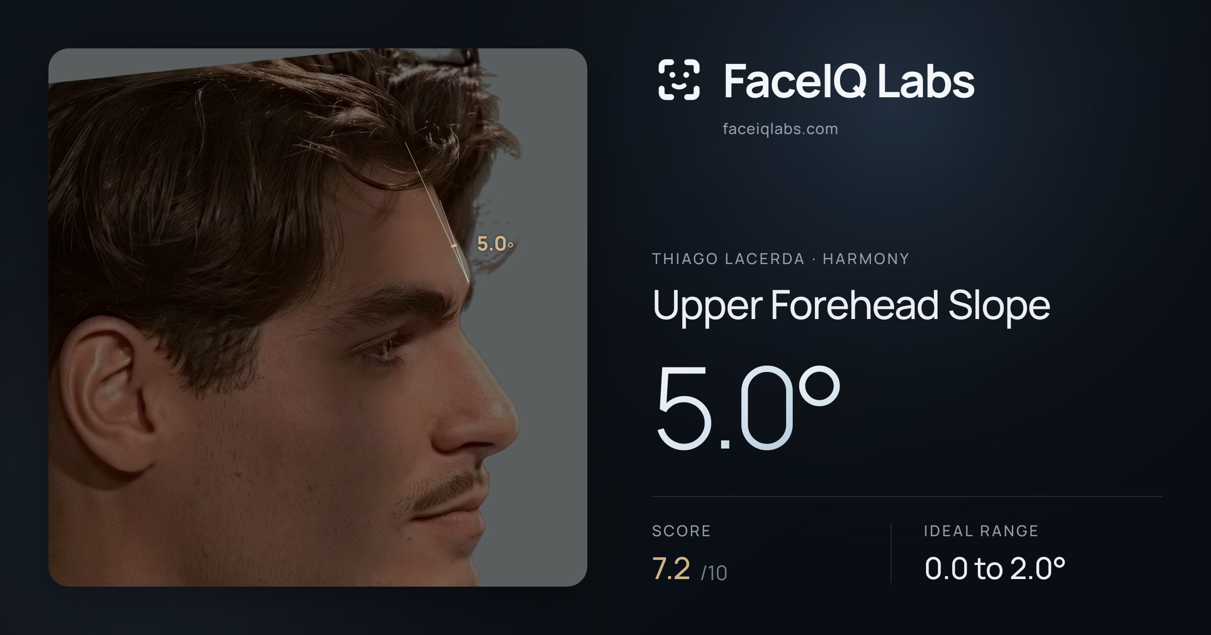 Thiago Lacerda Upper Forehead Slope: 5.0°, drawn on the photo