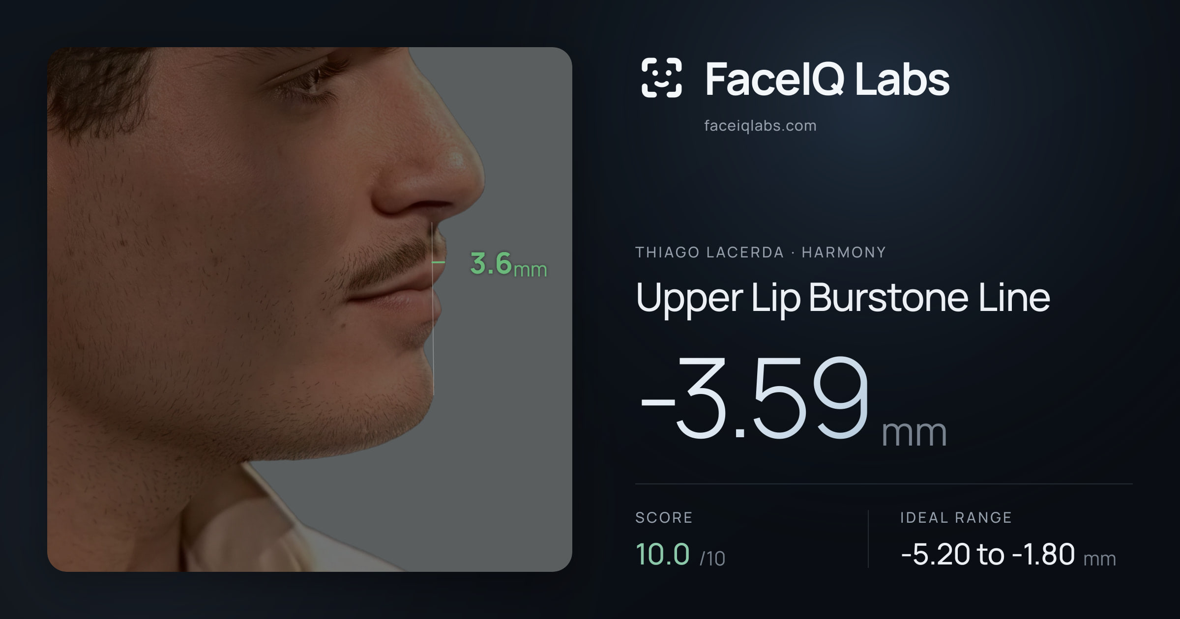 Thiago Lacerda Upper Lip Burstone Line: -3.59mm, drawn on the photo