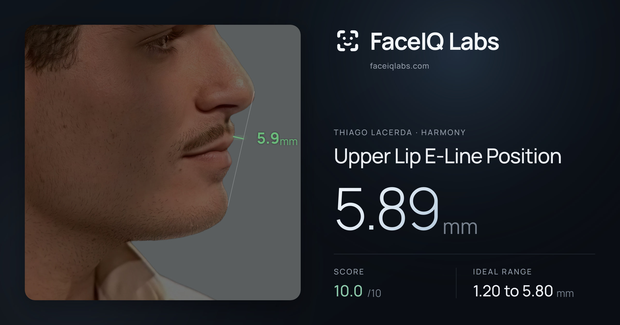 Thiago Lacerda Upper Lip E-Line Position: 5.89mm, drawn on the photo