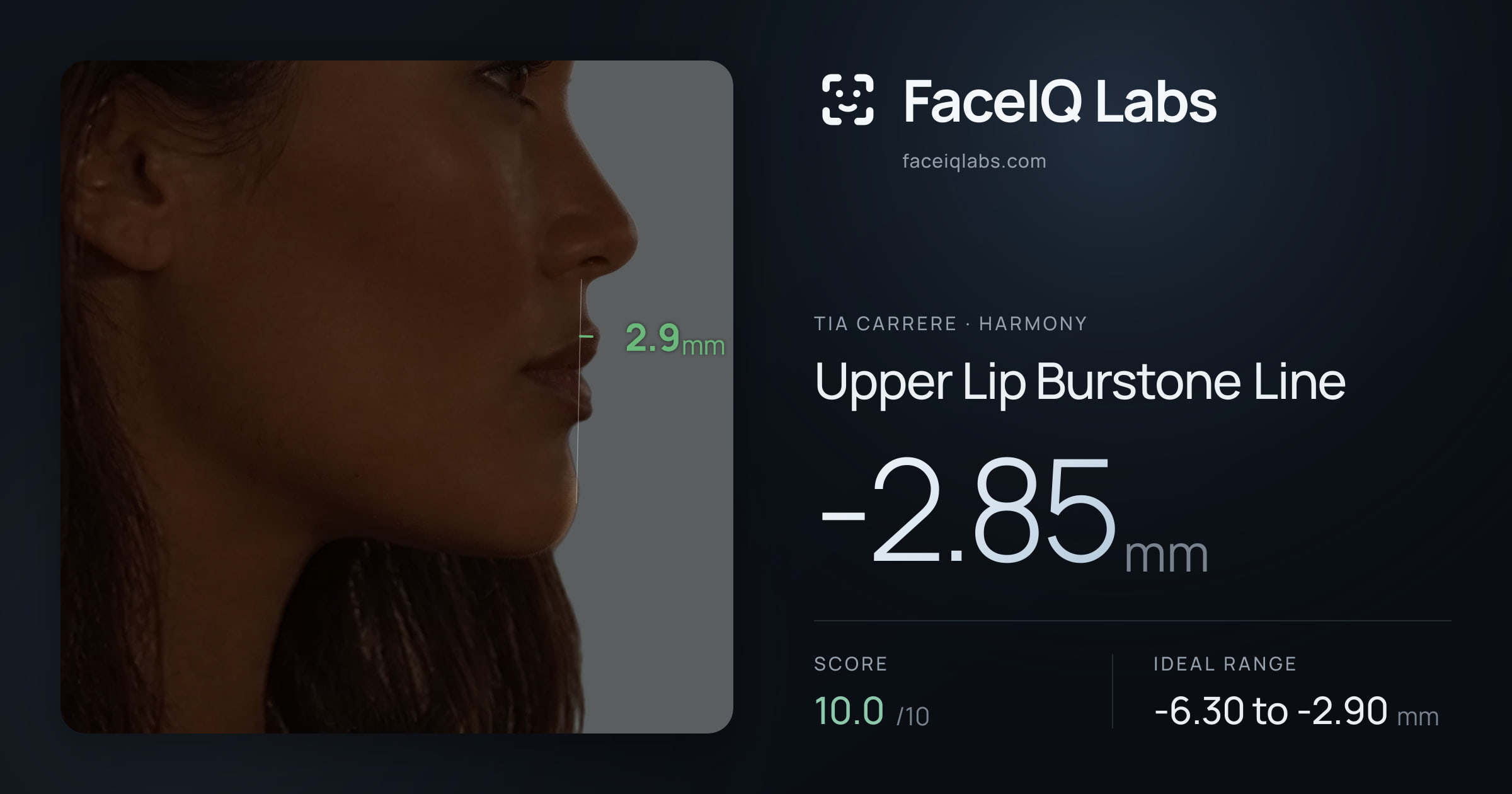 Tia Carrere Upper Lip Burstone Line: -2.85mm, drawn on the photo