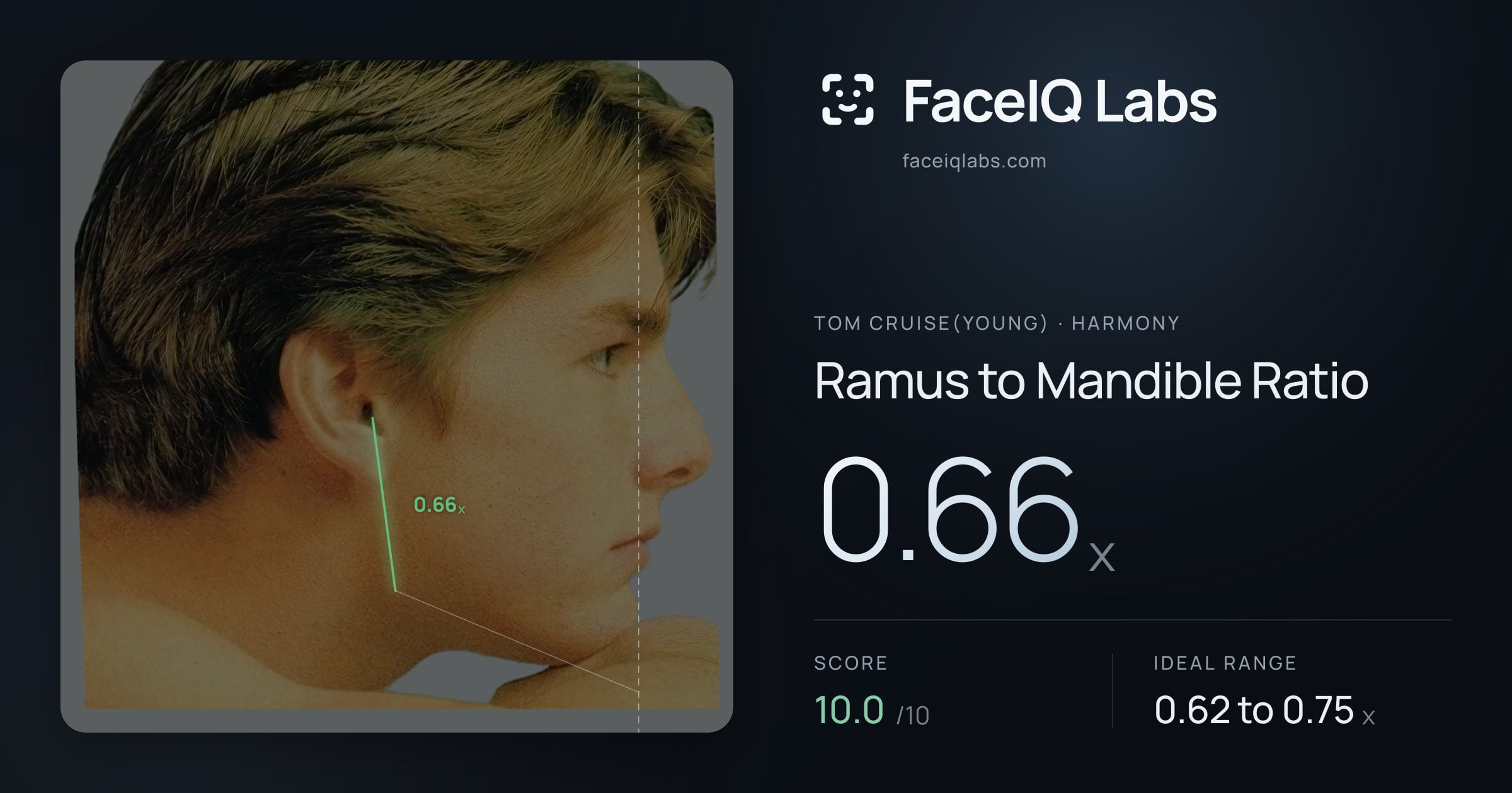 Tom Cruise(Young) Ramus to Mandible Ratio: 0.66x, drawn on the photo