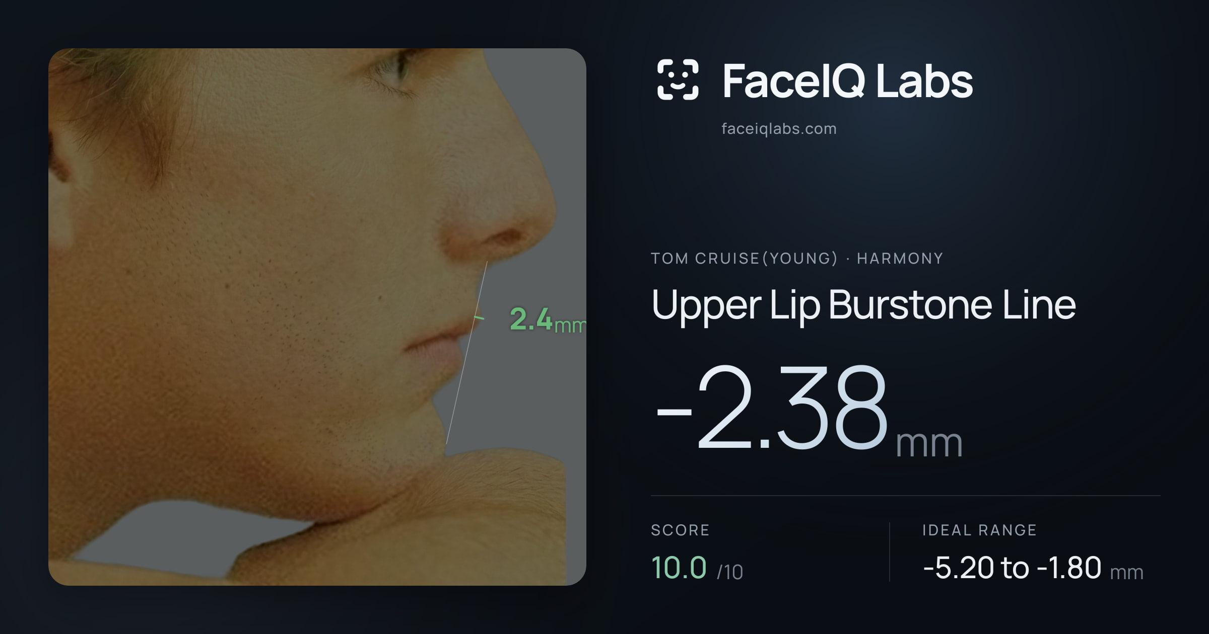 Tom Cruise(Young) Upper Lip Burstone Line: -2.38mm, drawn on the photo