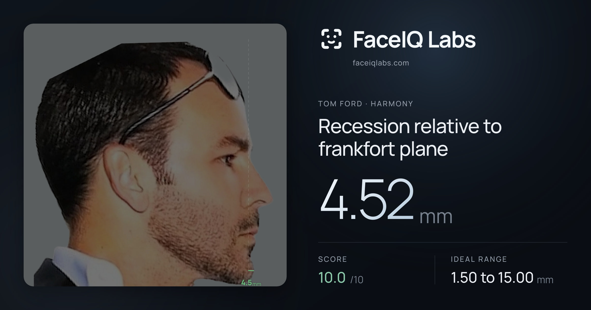 Tom Ford Recession relative to frankfort plane: 4.52mm, drawn on the photo