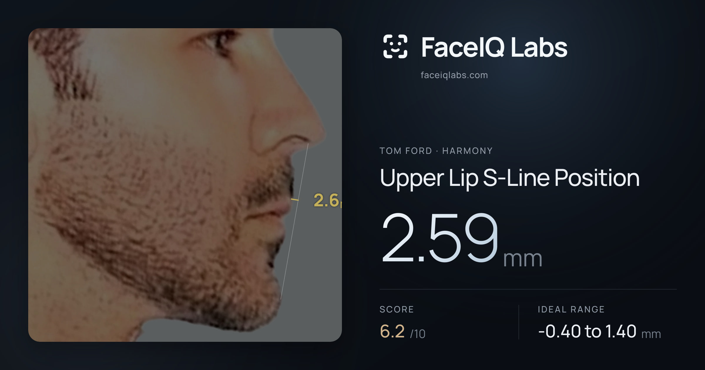 Tom Ford Upper Lip S-Line Position: 2.59mm, drawn on the photo