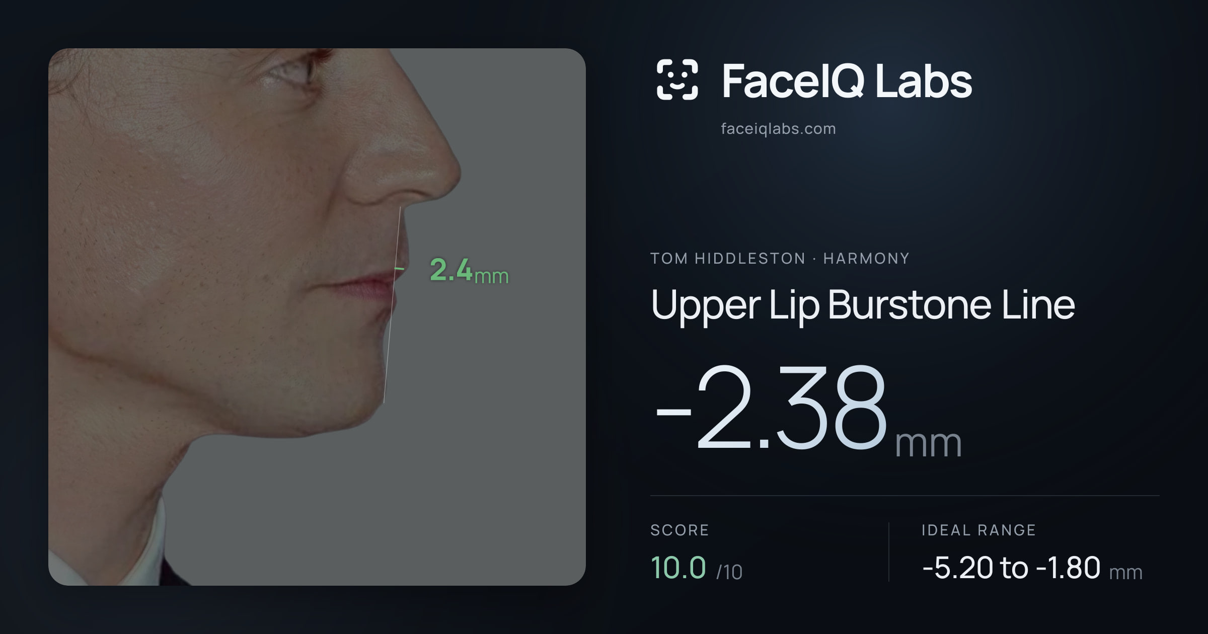 Tom Hiddleston Upper Lip Burstone Line: -2.38mm, drawn on the photo