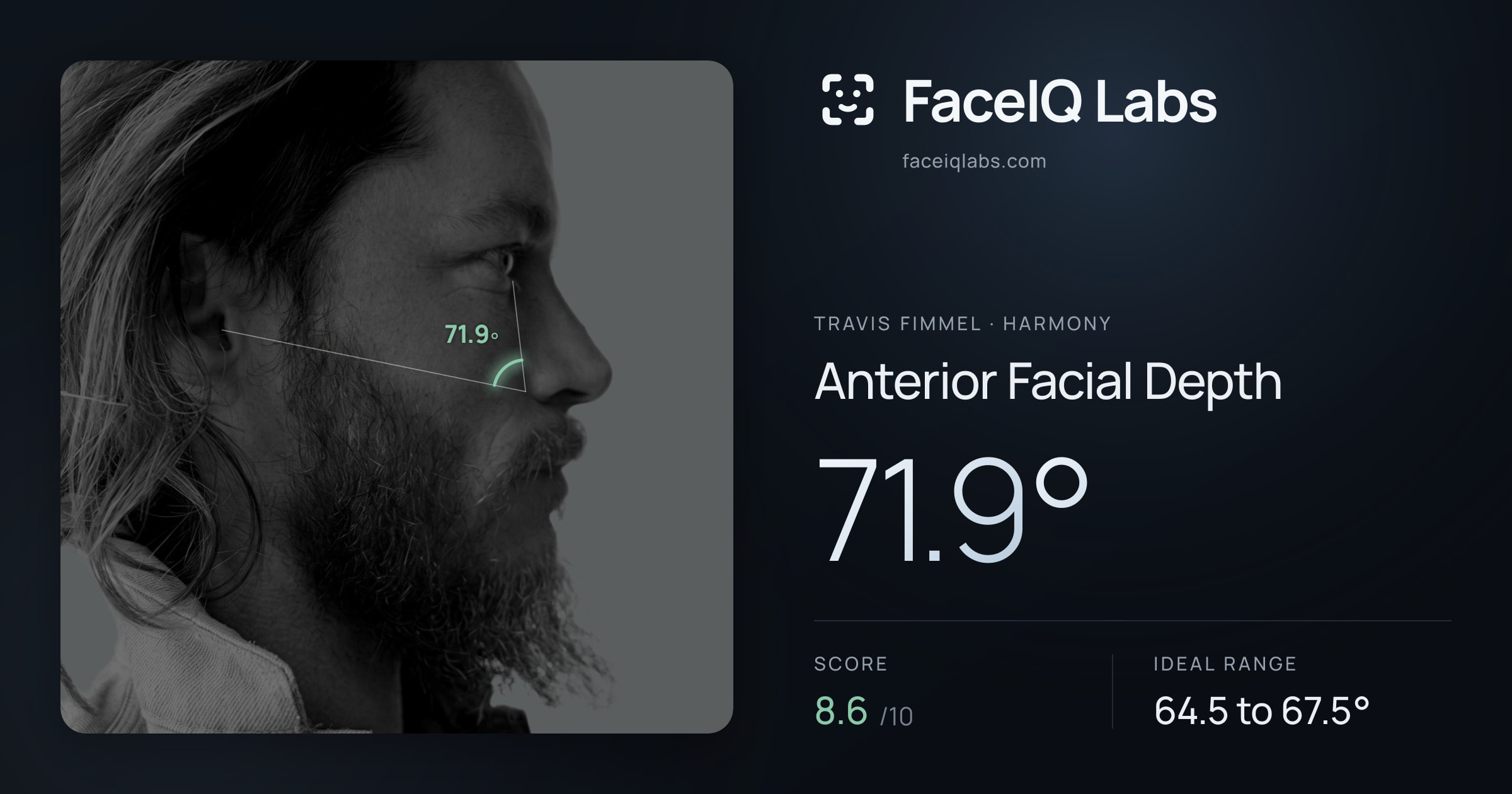 Travis Fimmel Anterior Facial Depth: 71.9°, drawn on the photo