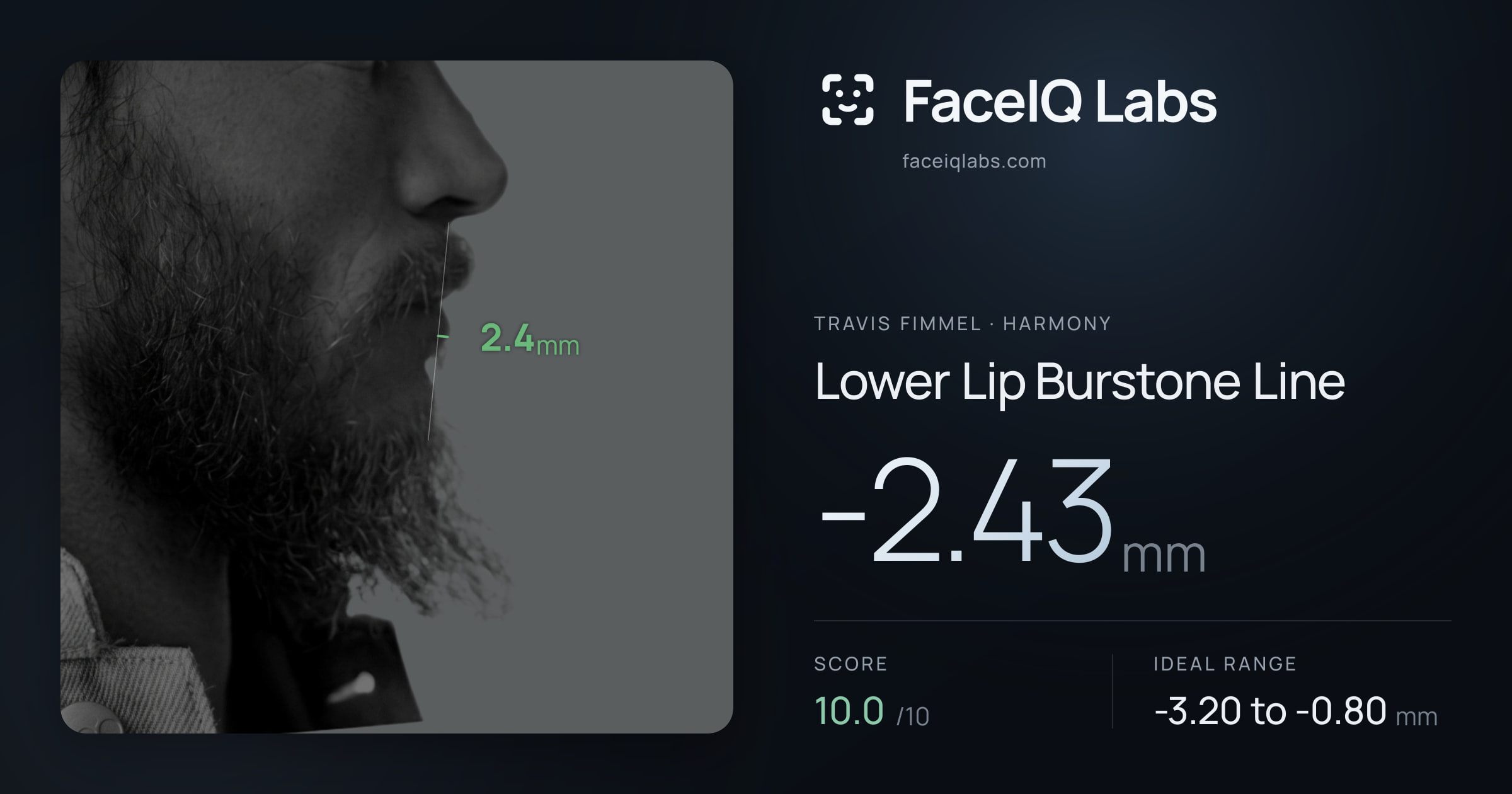 Travis Fimmel Lower Lip Burstone Line: -2.43mm, drawn on the photo