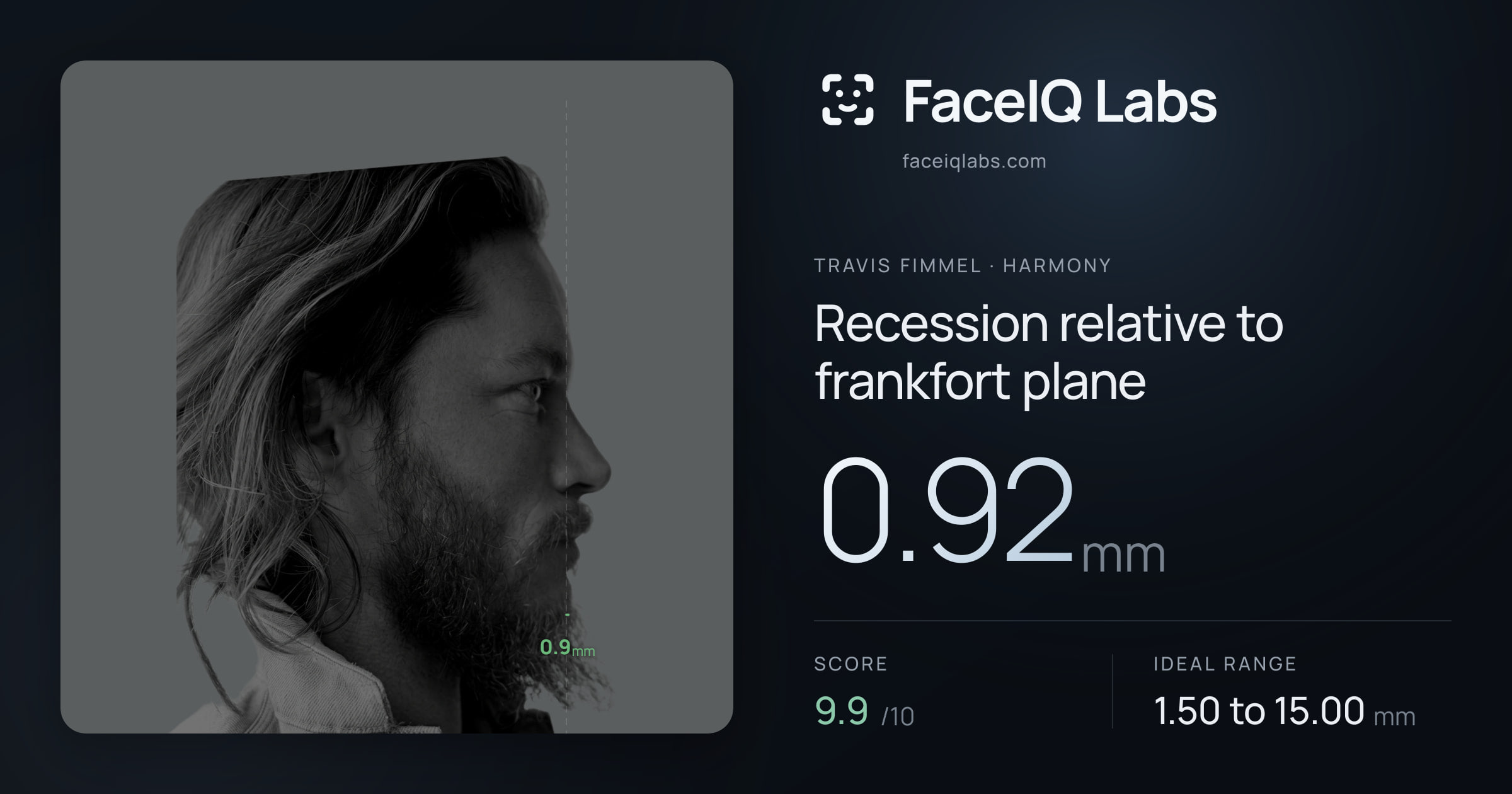 Travis Fimmel Recession relative to frankfort plane: 0.92mm, drawn on the photo