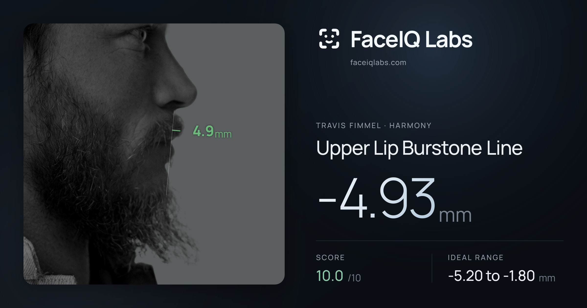 Travis Fimmel Upper Lip Burstone Line: -4.93mm, drawn on the photo