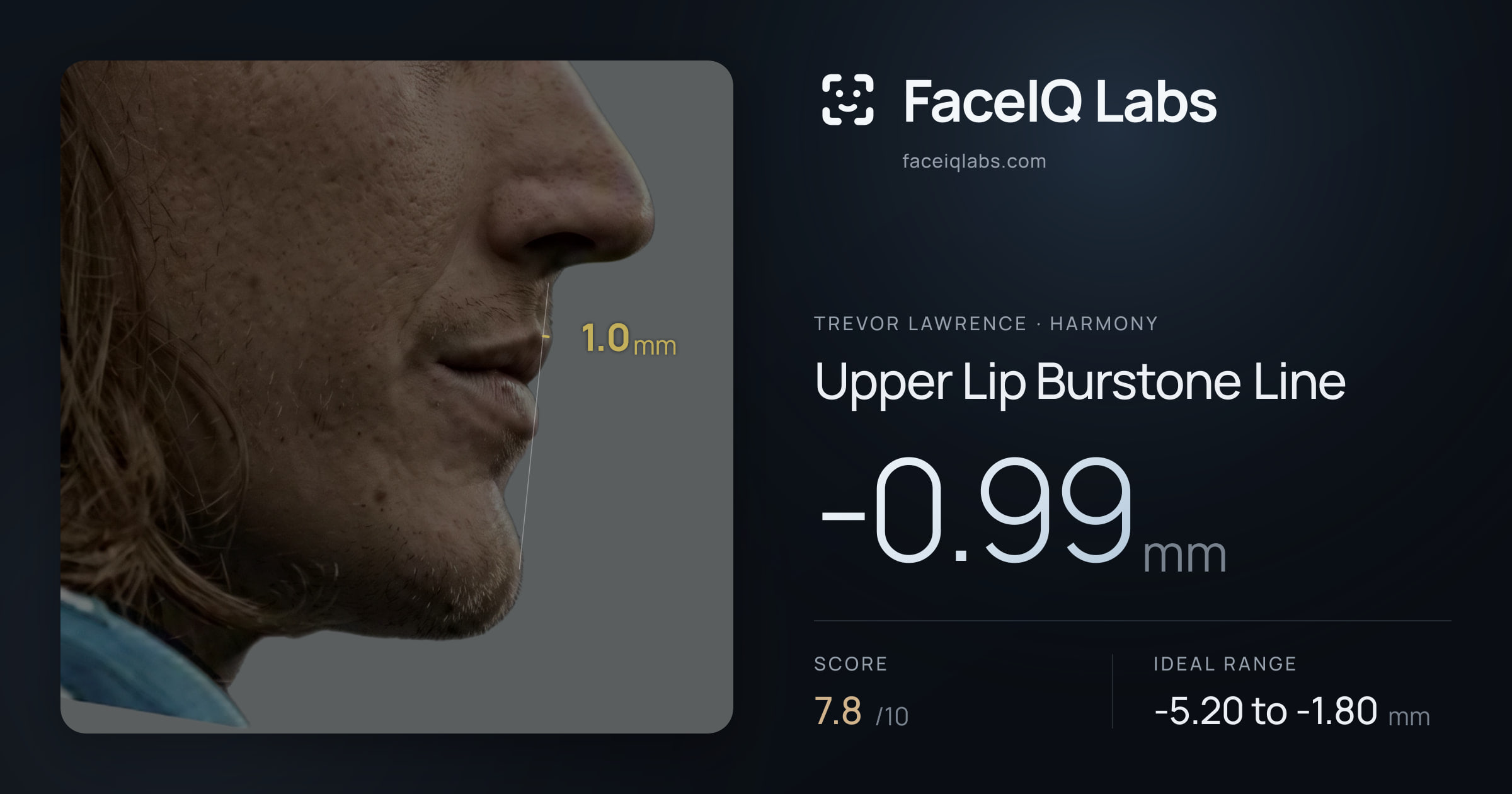 Trevor Lawrence Upper Lip Burstone Line: -0.99mm, drawn on the photo