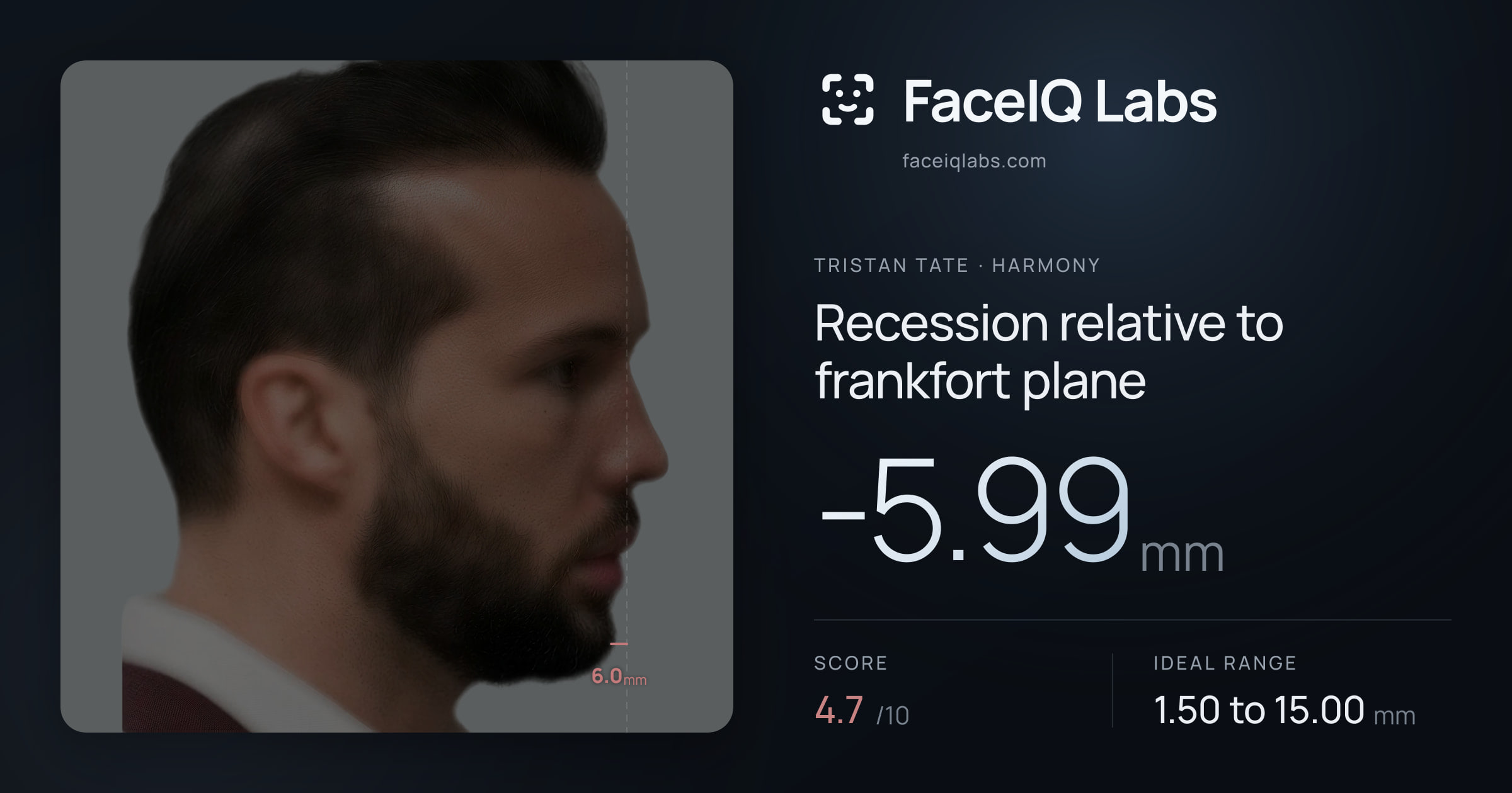 Tristan Tate Recession relative to frankfort plane: -5.99mm, drawn on the photo