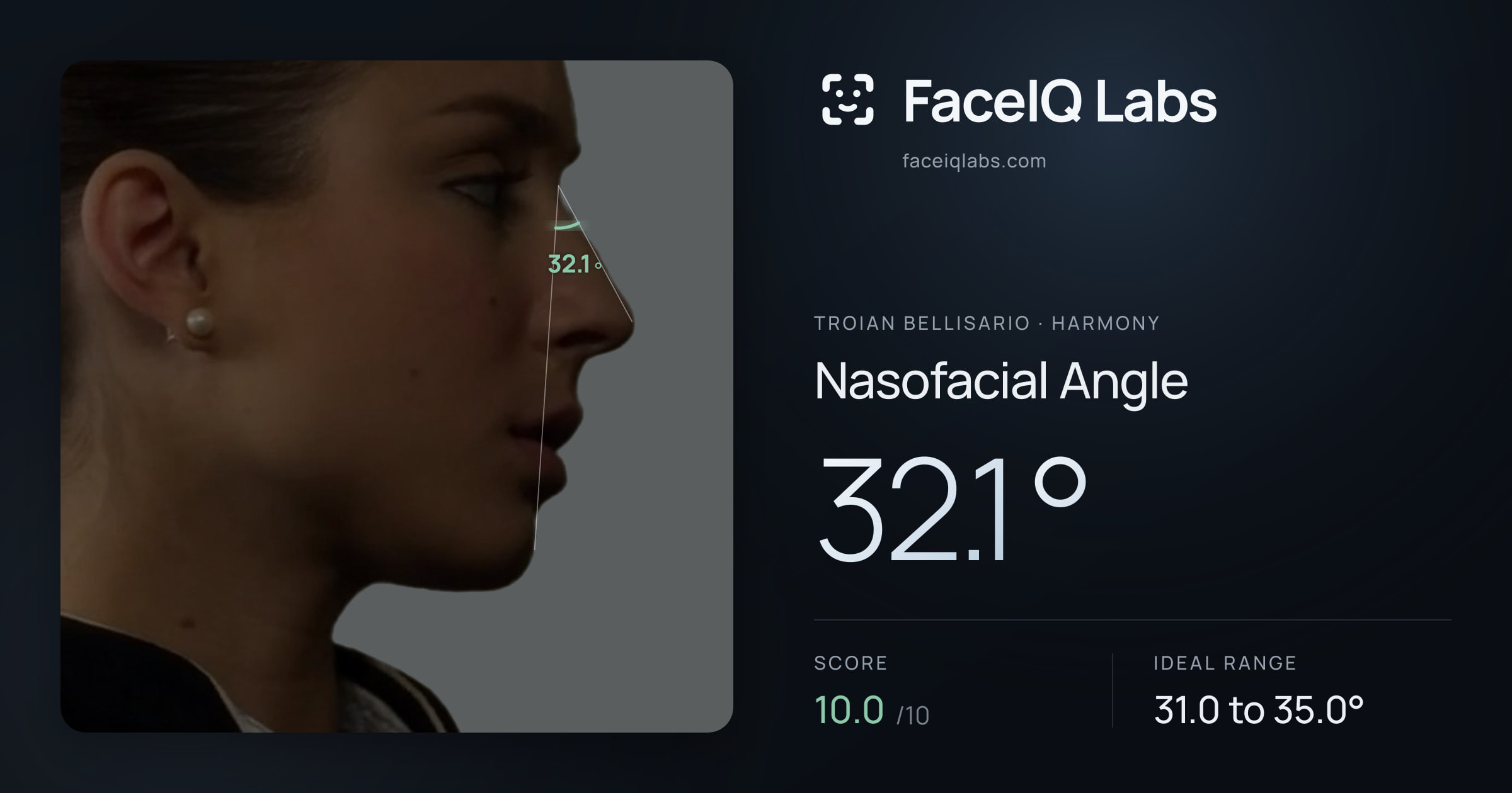 Troian Bellisario Nasofacial Angle: 32.1°, drawn on the photo