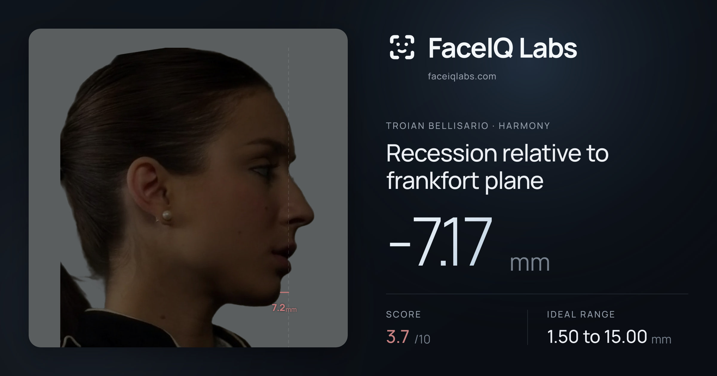 Troian Bellisario Recession relative to frankfort plane: -7.17mm, drawn on the photo