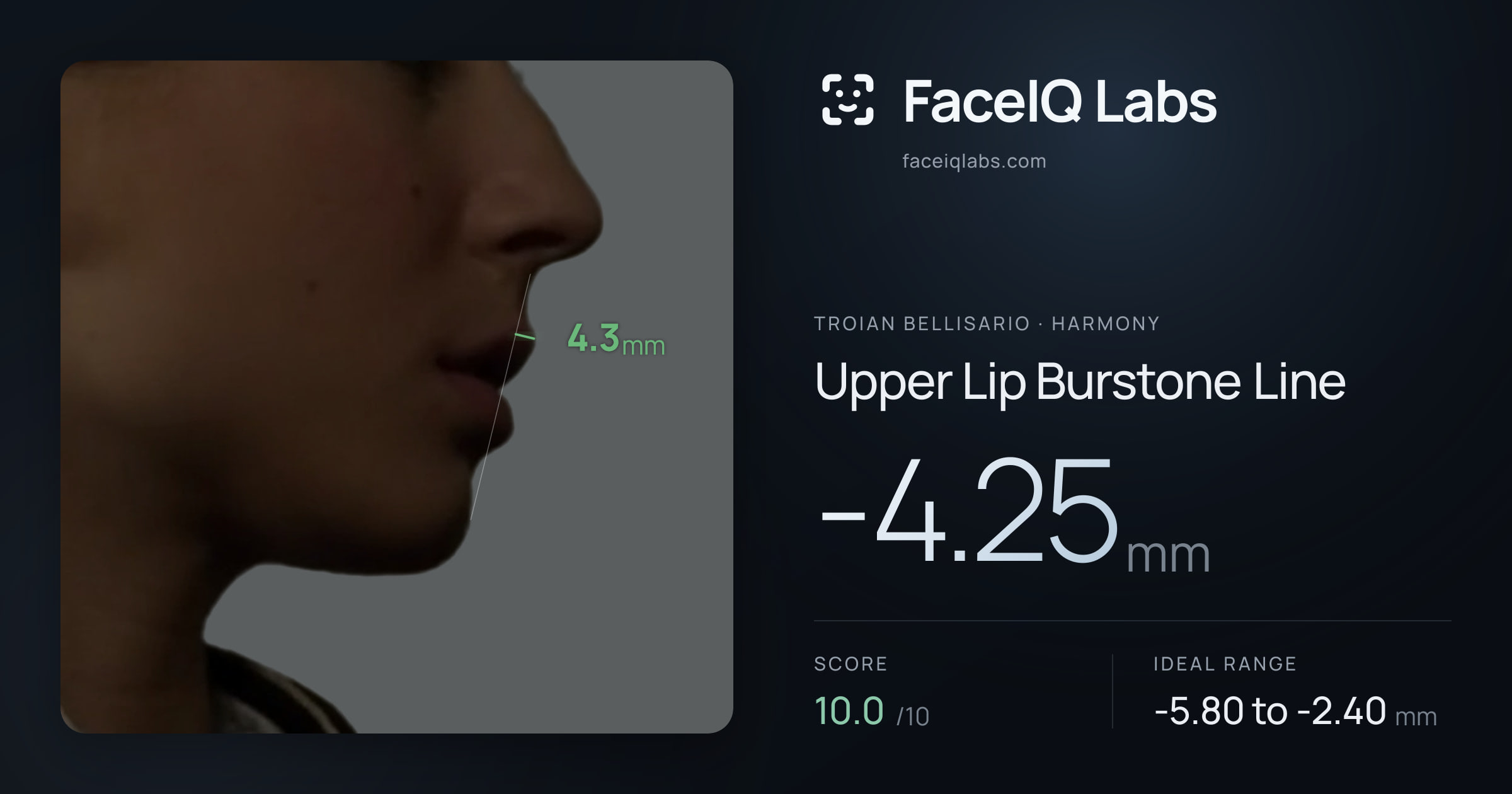 Troian Bellisario Upper Lip Burstone Line: -4.25mm, drawn on the photo