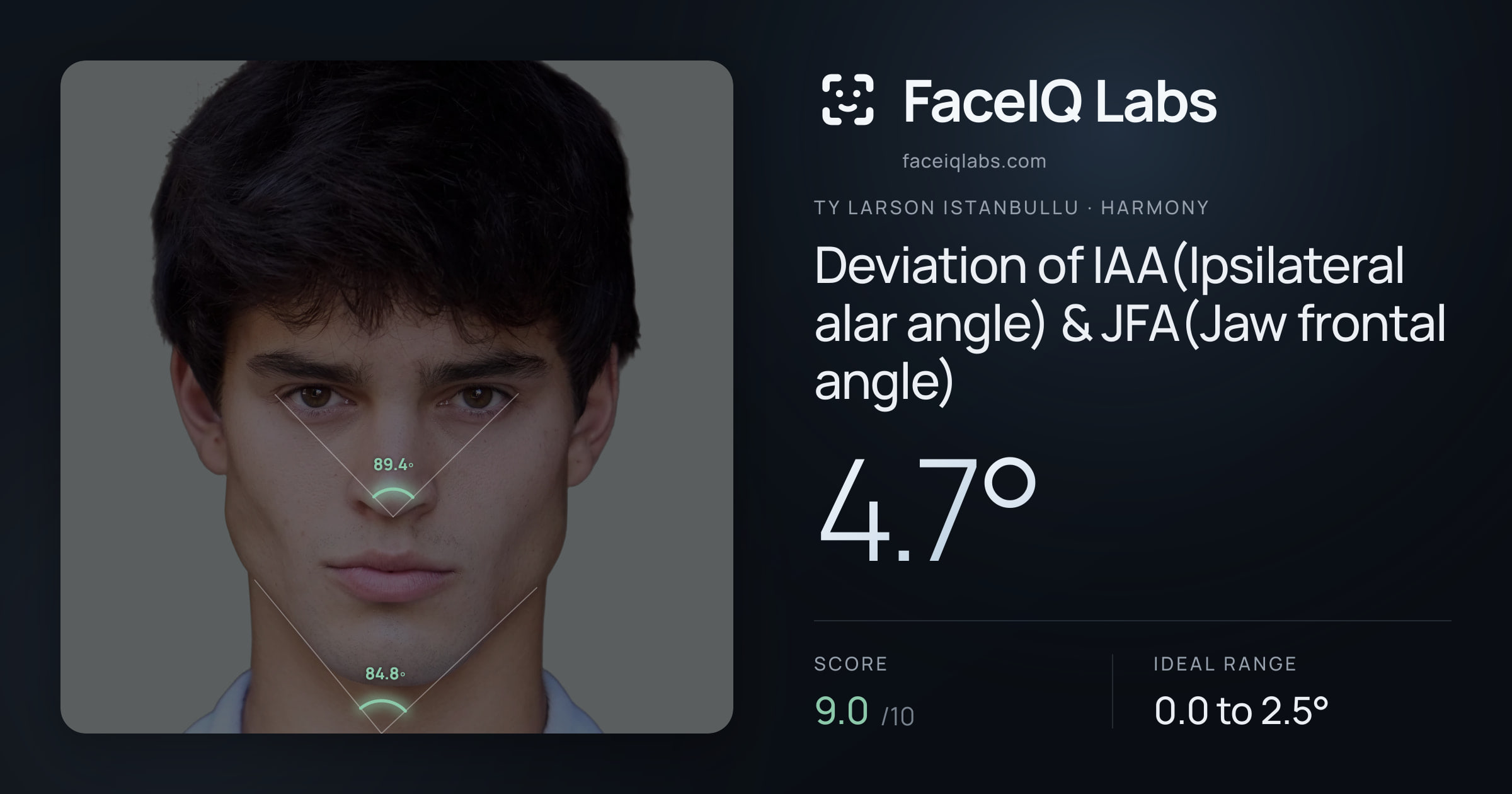 Ty Larson Istanbullu Deviation of IAA(Ipsilateral alar angle) & JFA(Jaw frontal angle): 4.7°, drawn on the photo