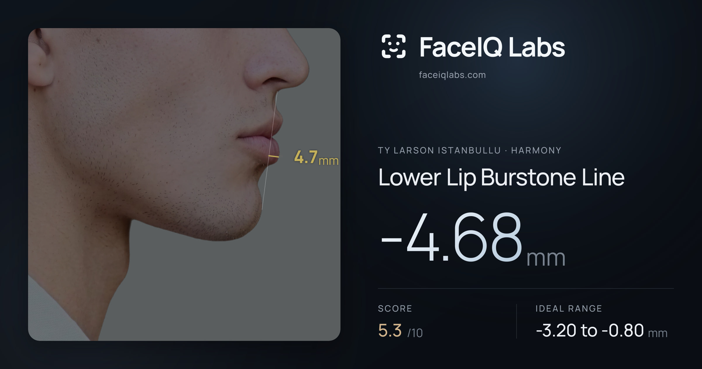 Ty Larson Istanbullu Lower Lip Burstone Line: -4.68mm, drawn on the photo