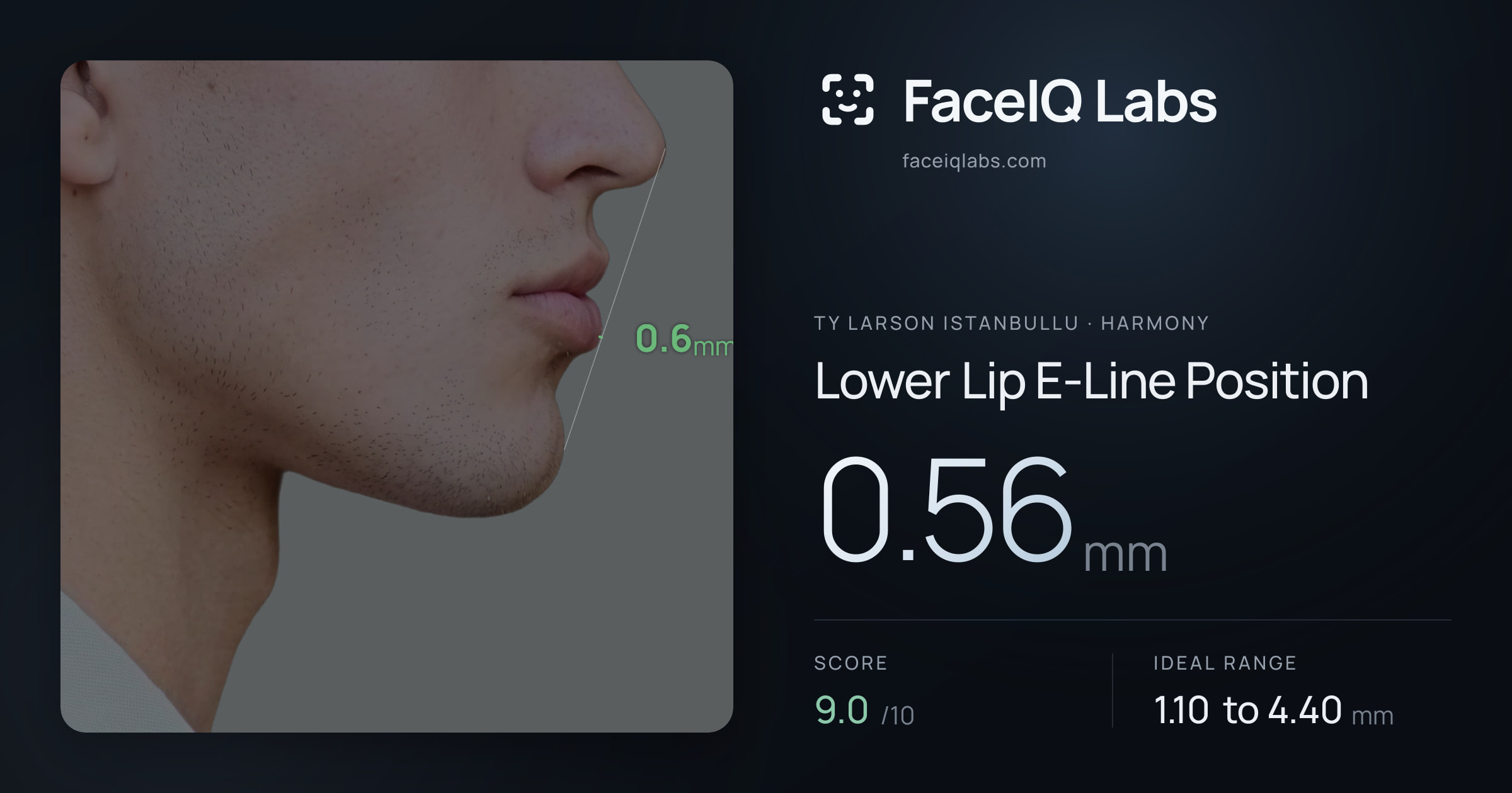 Ty Larson Istanbullu Lower Lip E-Line Position: 0.56mm, drawn on the photo
