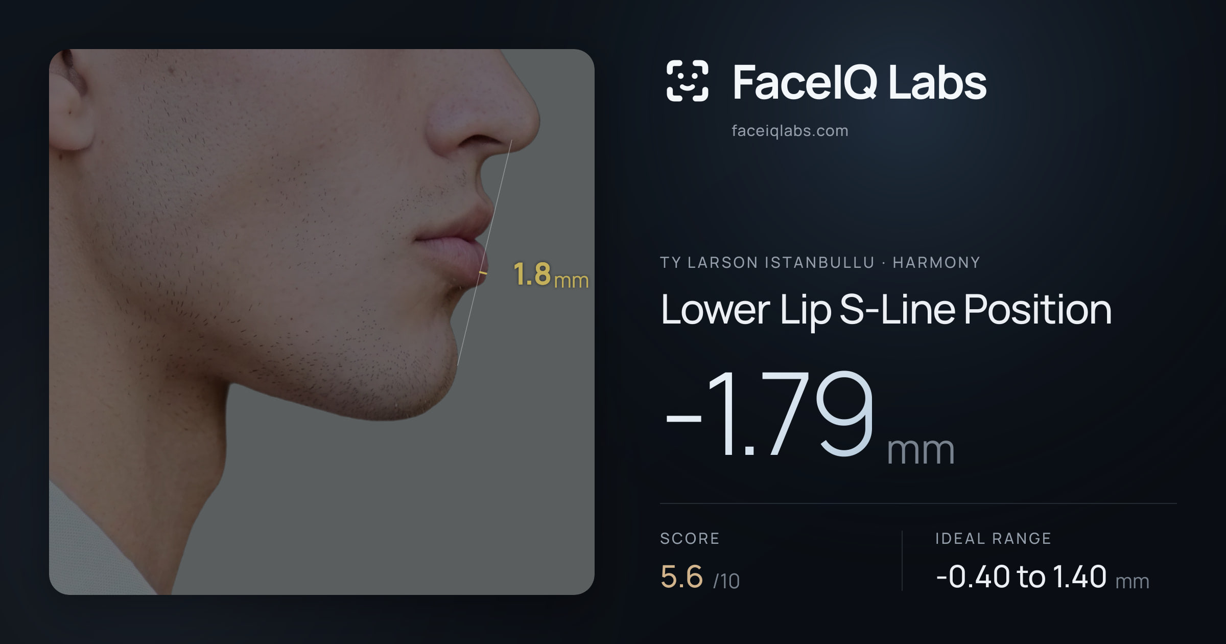 Ty Larson Istanbullu Lower Lip S-Line Position: -1.79mm, drawn on the photo