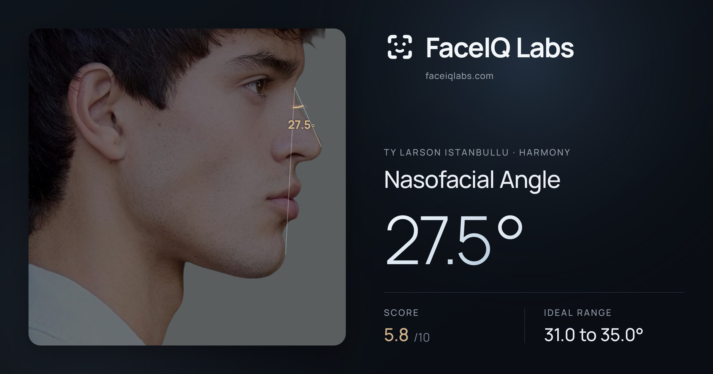 Ty Larson Istanbullu Nasofacial Angle: 27.5°, drawn on the photo