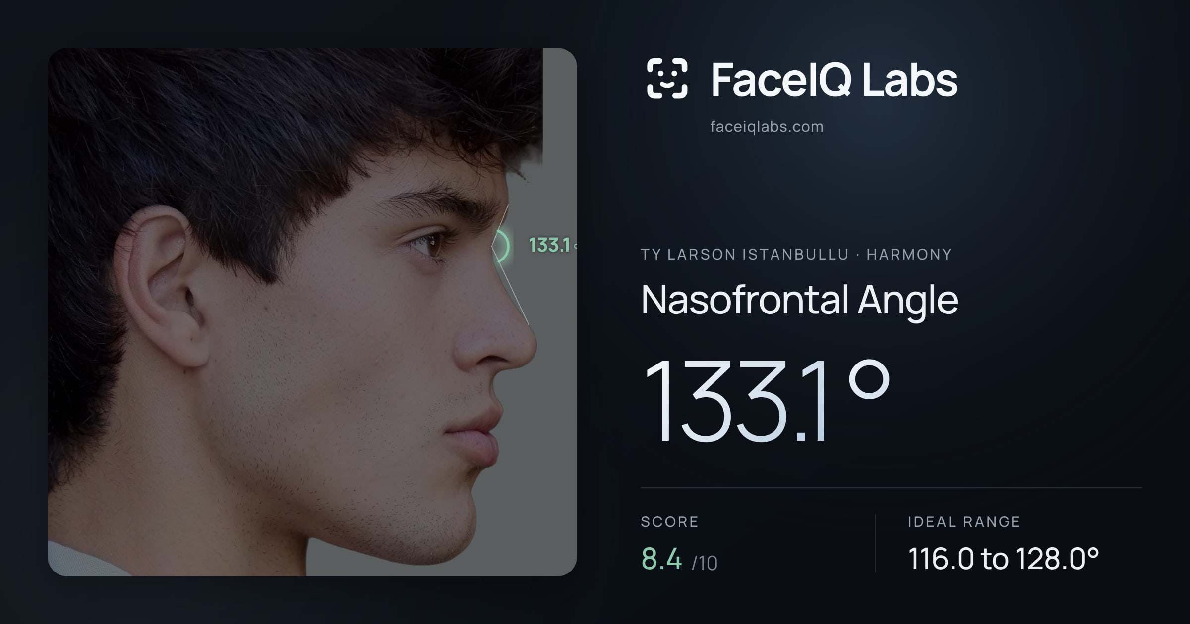 Ty Larson Istanbullu Nasofrontal Angle: 133.1°, drawn on the photo