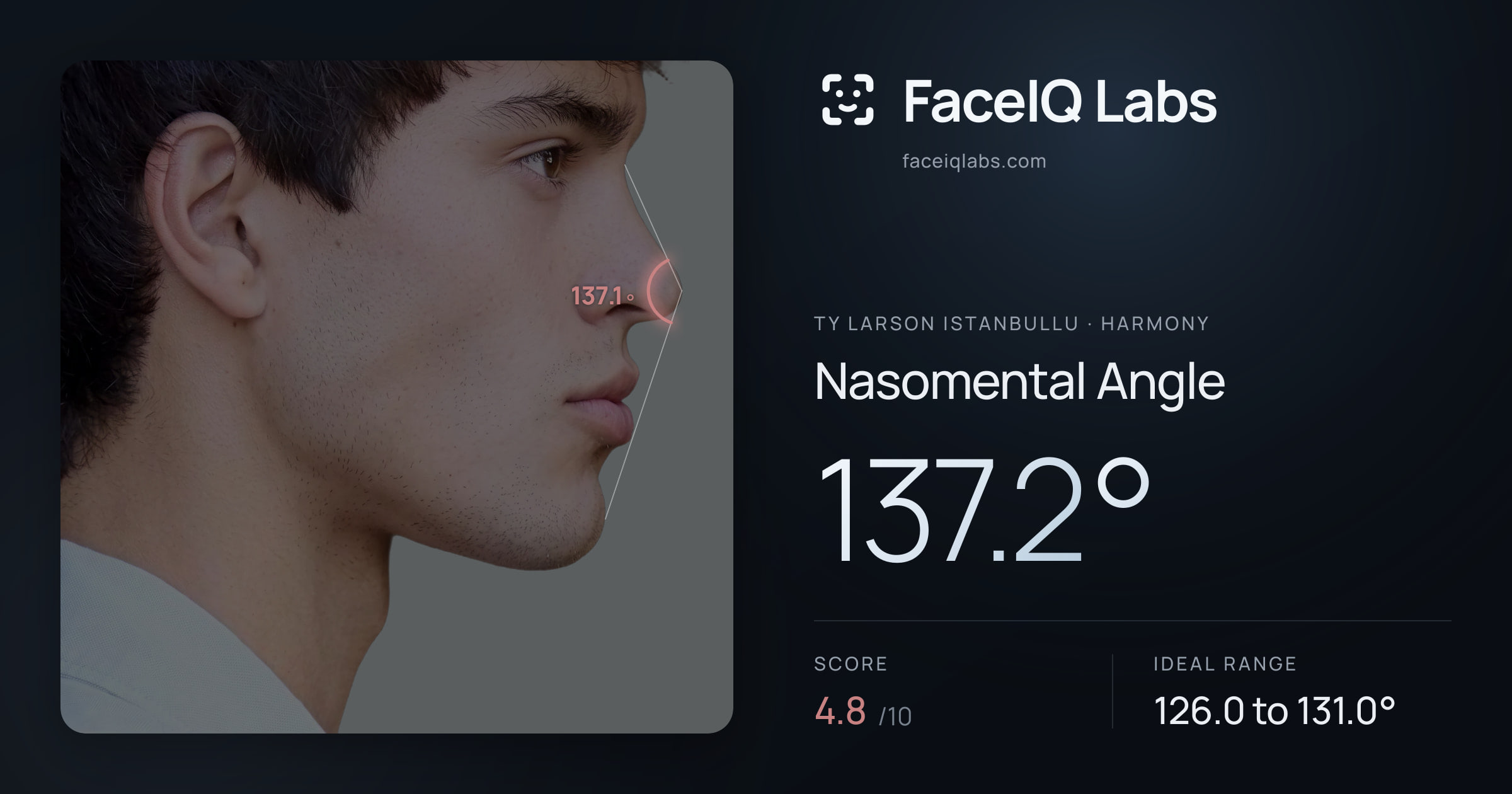 Ty Larson Istanbullu Nasomental Angle: 137.2°, drawn on the photo