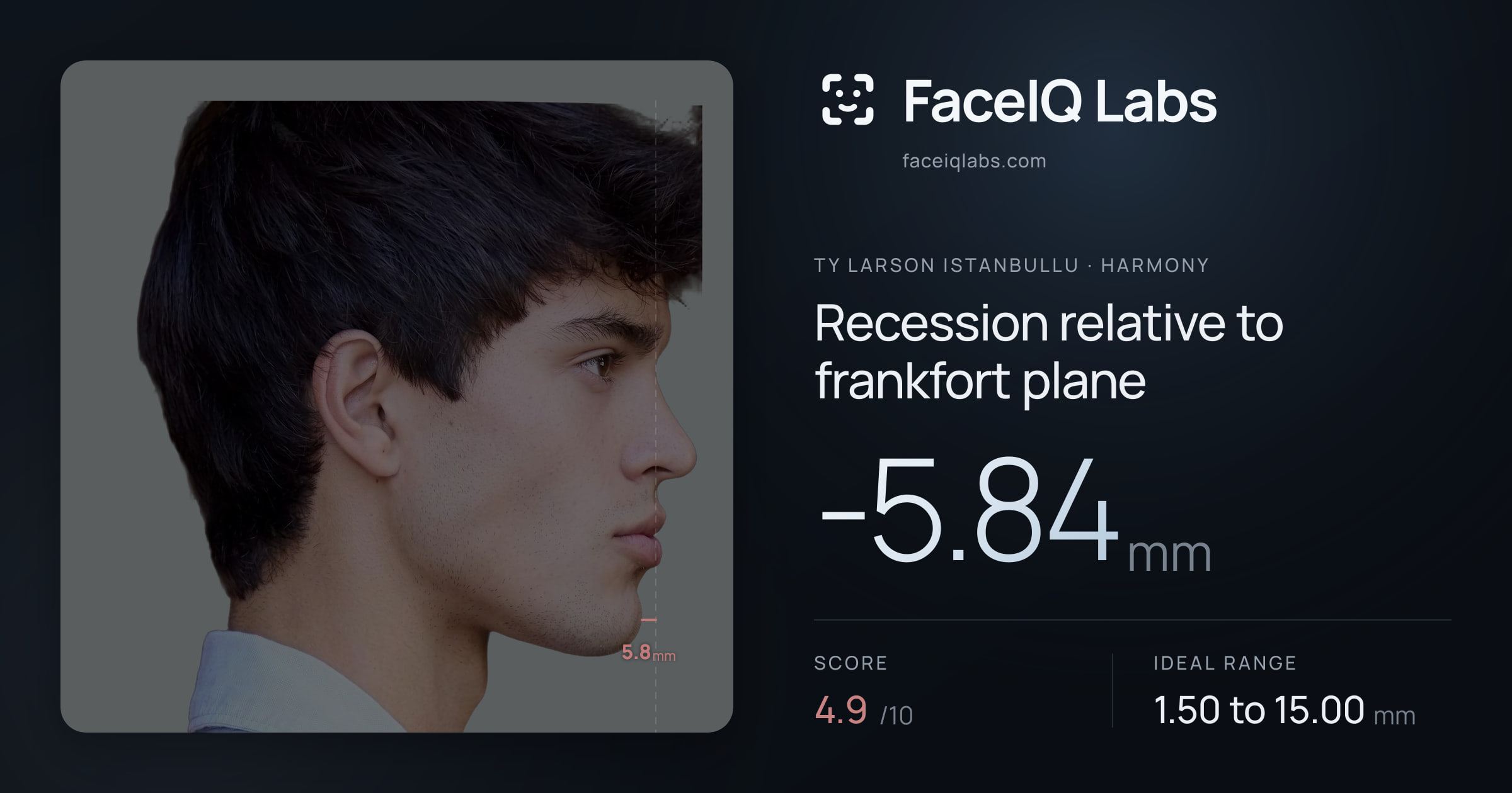Ty Larson Istanbullu Recession relative to frankfort plane: -5.84mm, drawn on the photo
