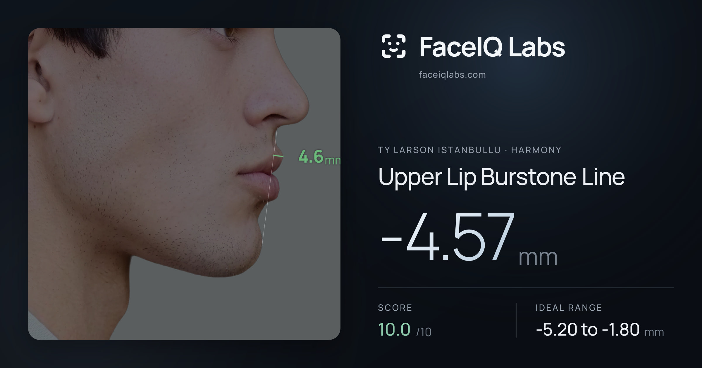 Ty Larson Istanbullu Upper Lip Burstone Line: -4.57mm, drawn on the photo