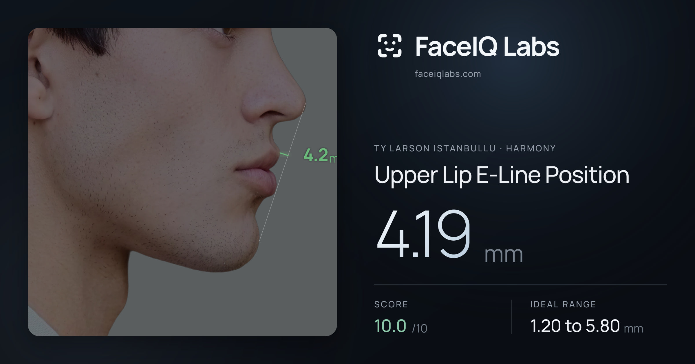 Ty Larson Istanbullu Upper Lip E-Line Position: 4.19mm, drawn on the photo