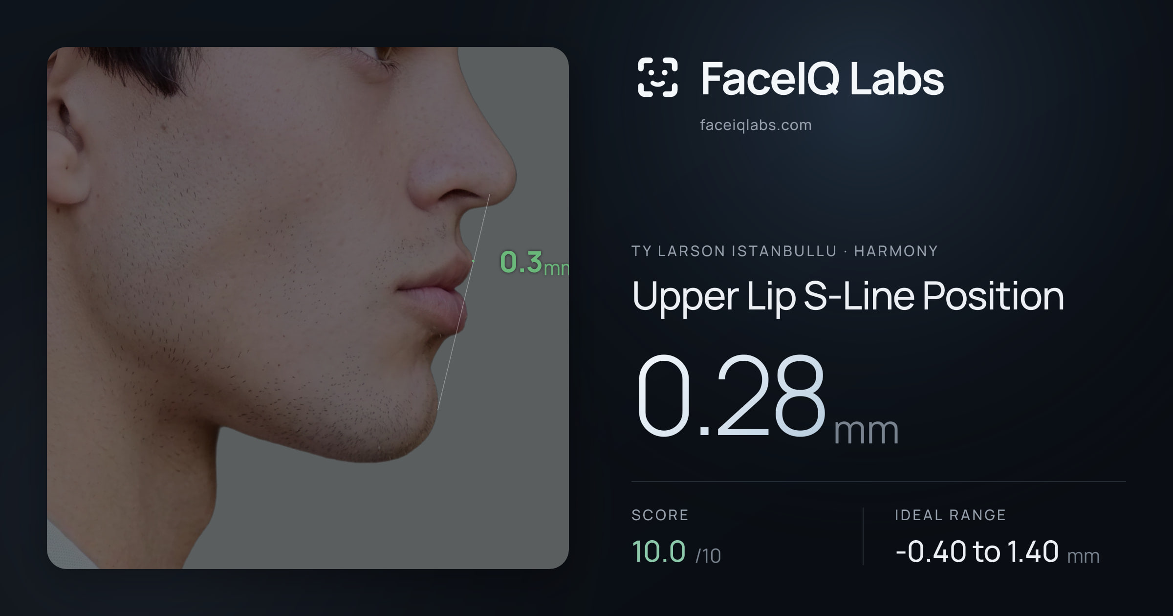 Ty Larson Istanbullu Upper Lip S-Line Position: 0.28mm, drawn on the photo