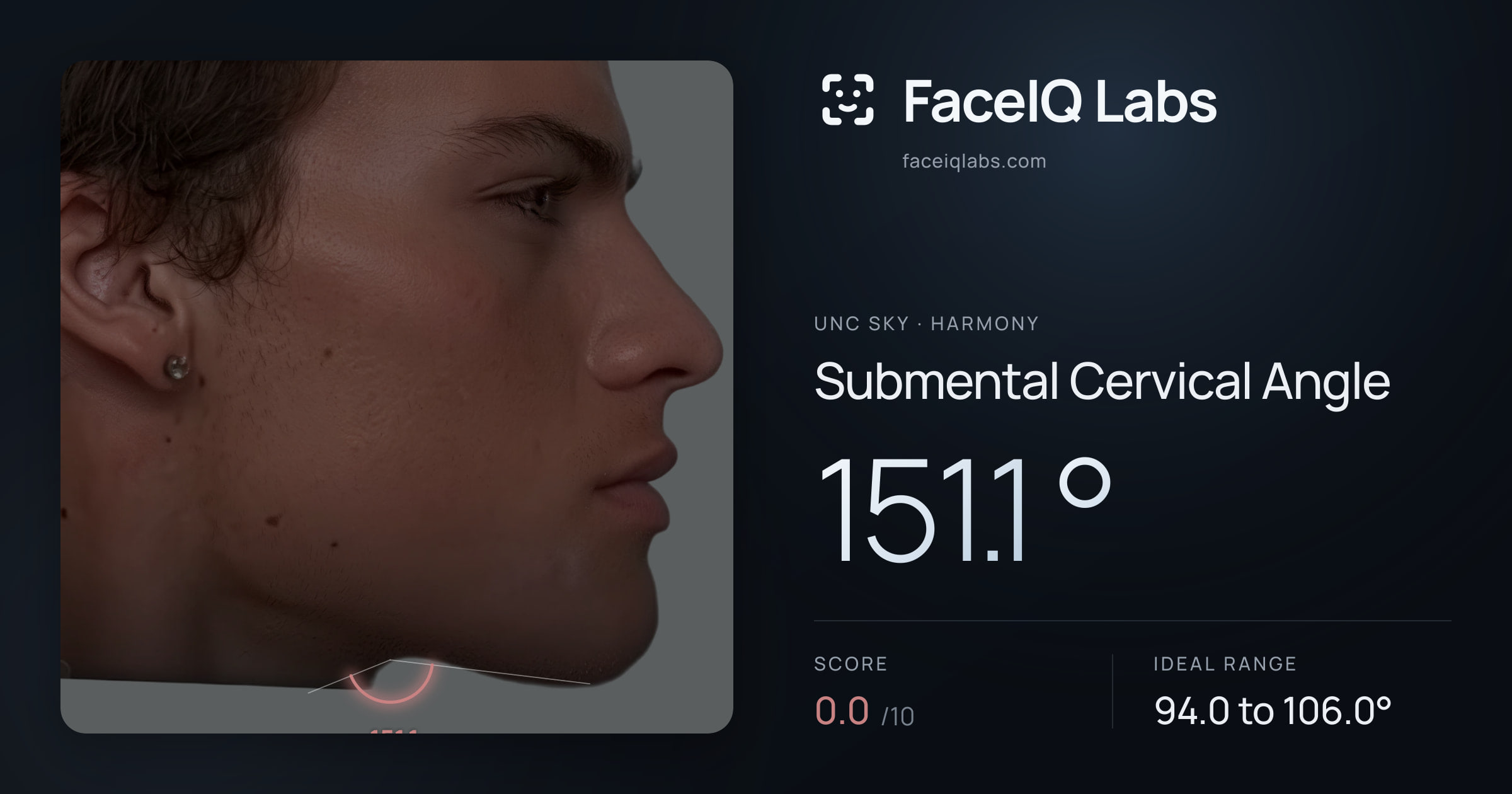 Unc Sky Submental Cervical Angle: 151.1°, drawn on the photo