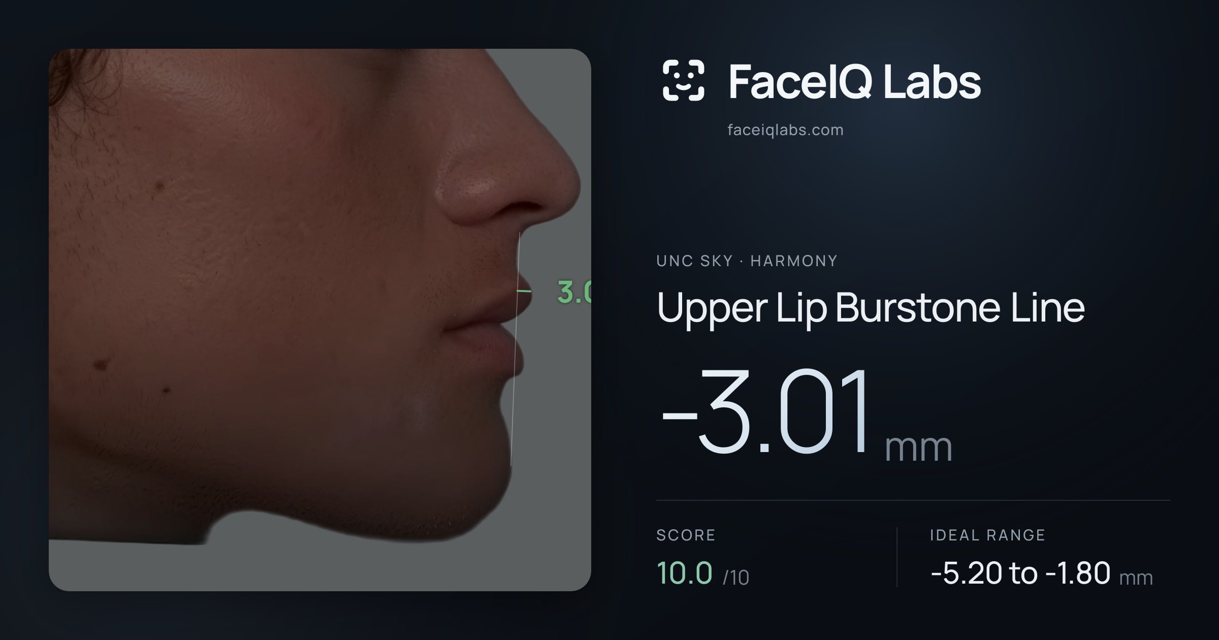 Unc Sky Upper Lip Burstone Line: -3.01mm, drawn on the photo