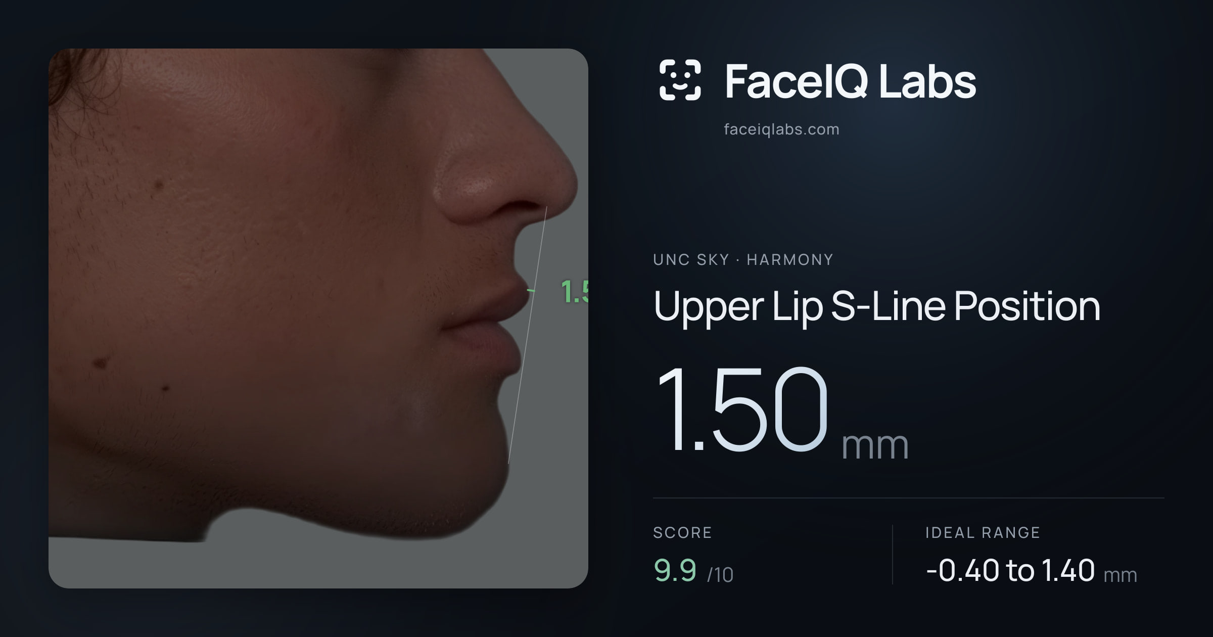 Unc Sky Upper Lip S-Line Position: 1.50mm, drawn on the photo