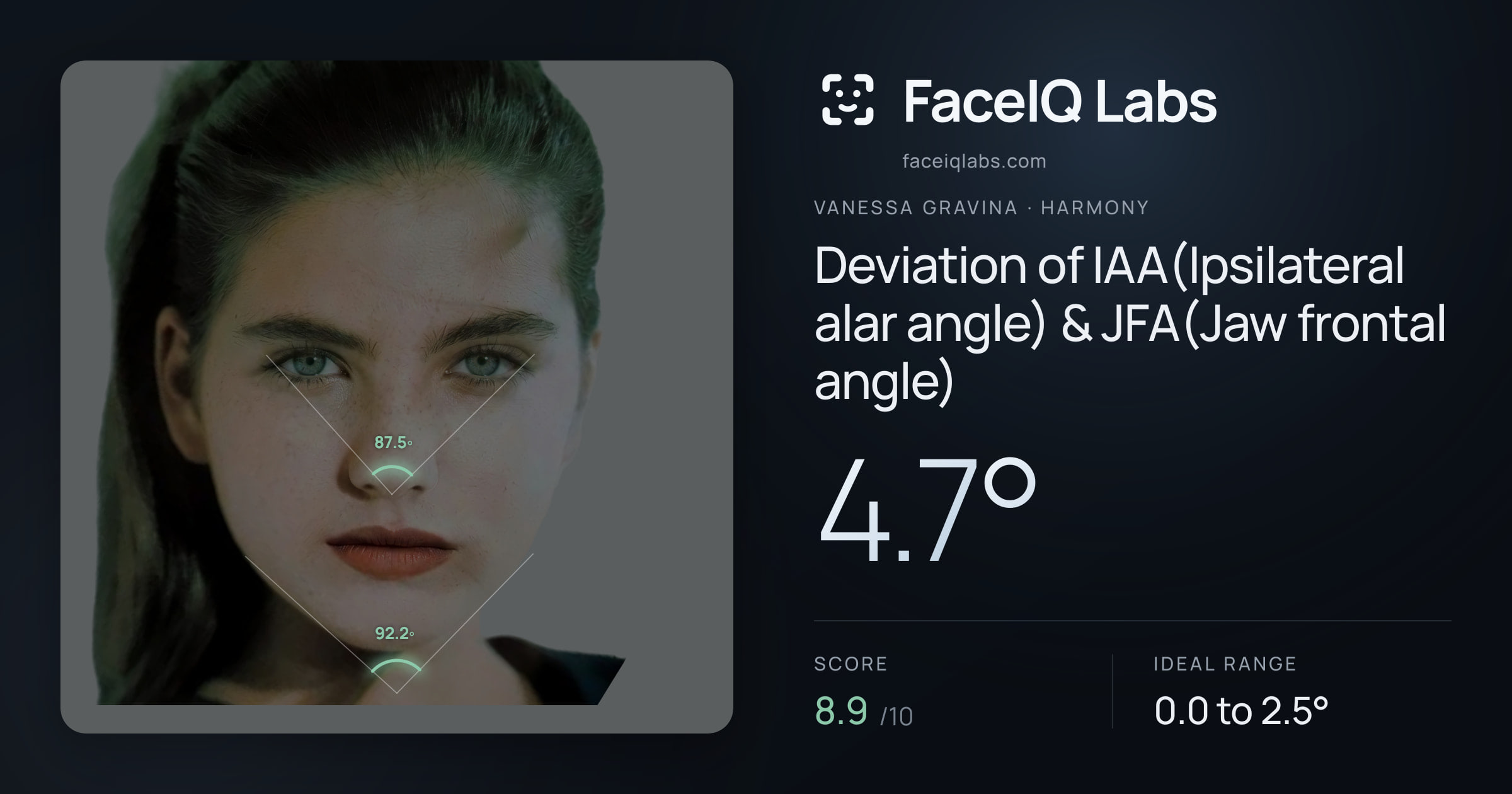 Vanessa Gravina Deviation of IAA(Ipsilateral alar angle) & JFA(Jaw frontal angle): 4.7°, drawn on the photo