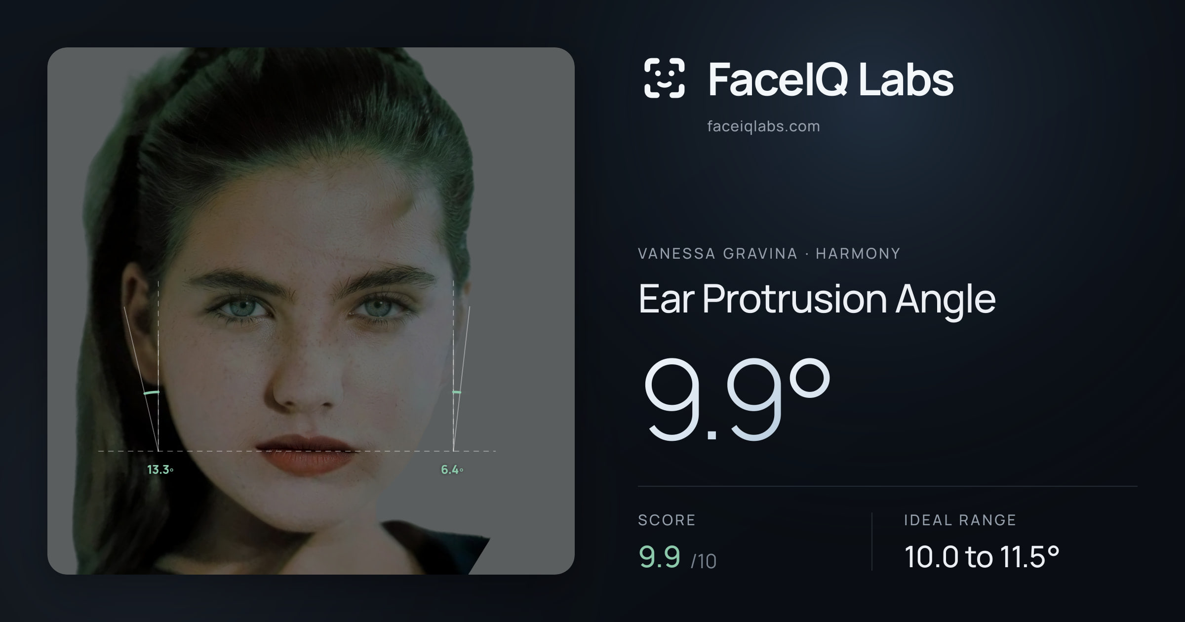 Vanessa Gravina Ear Protrusion Angle: 9.9°, drawn on the photo
