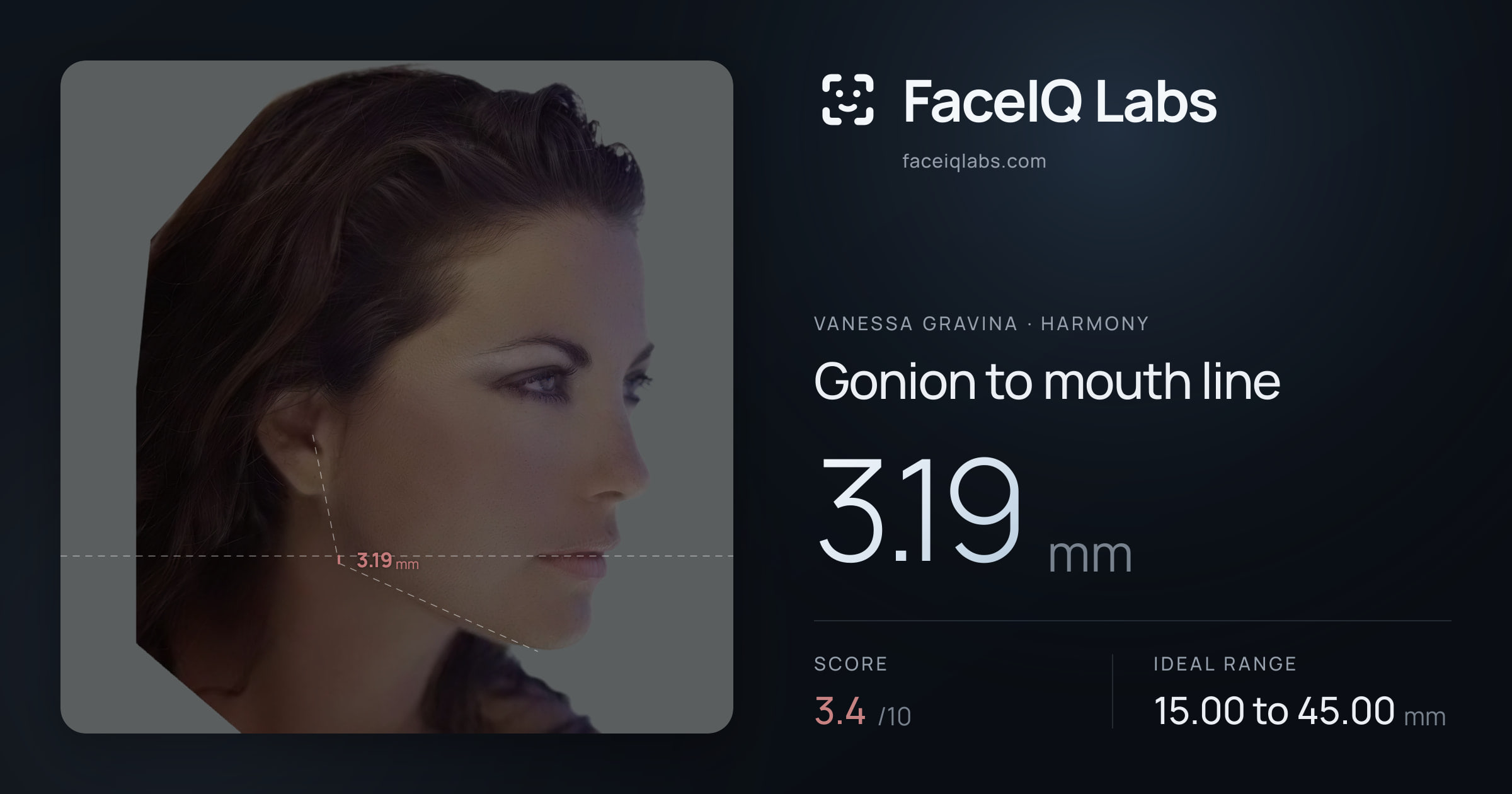 Vanessa Gravina Gonion to mouth line: 3.19mm, drawn on the photo