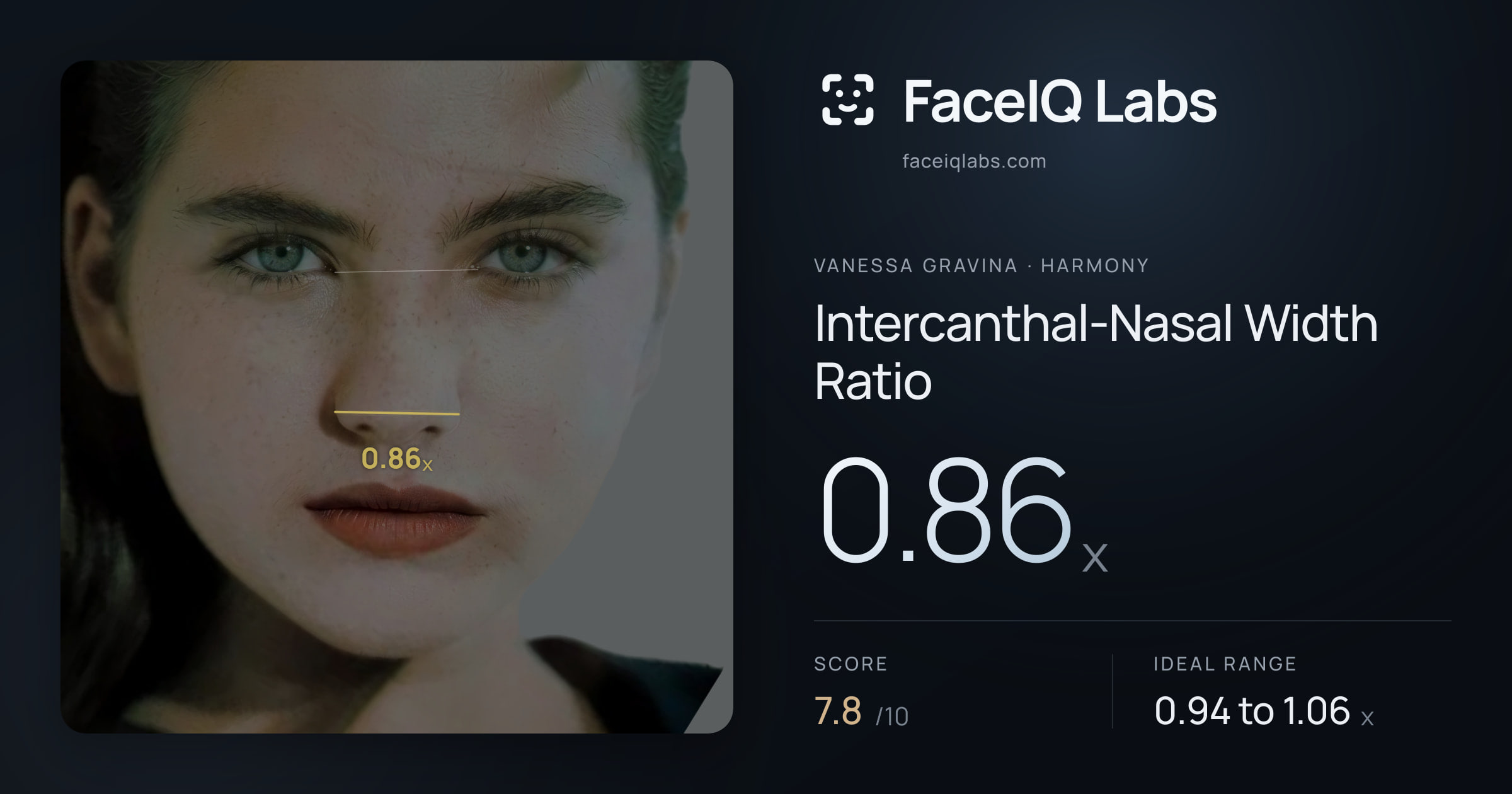 Vanessa Gravina Intercanthal-Nasal Width Ratio: 0.86x, drawn on the photo