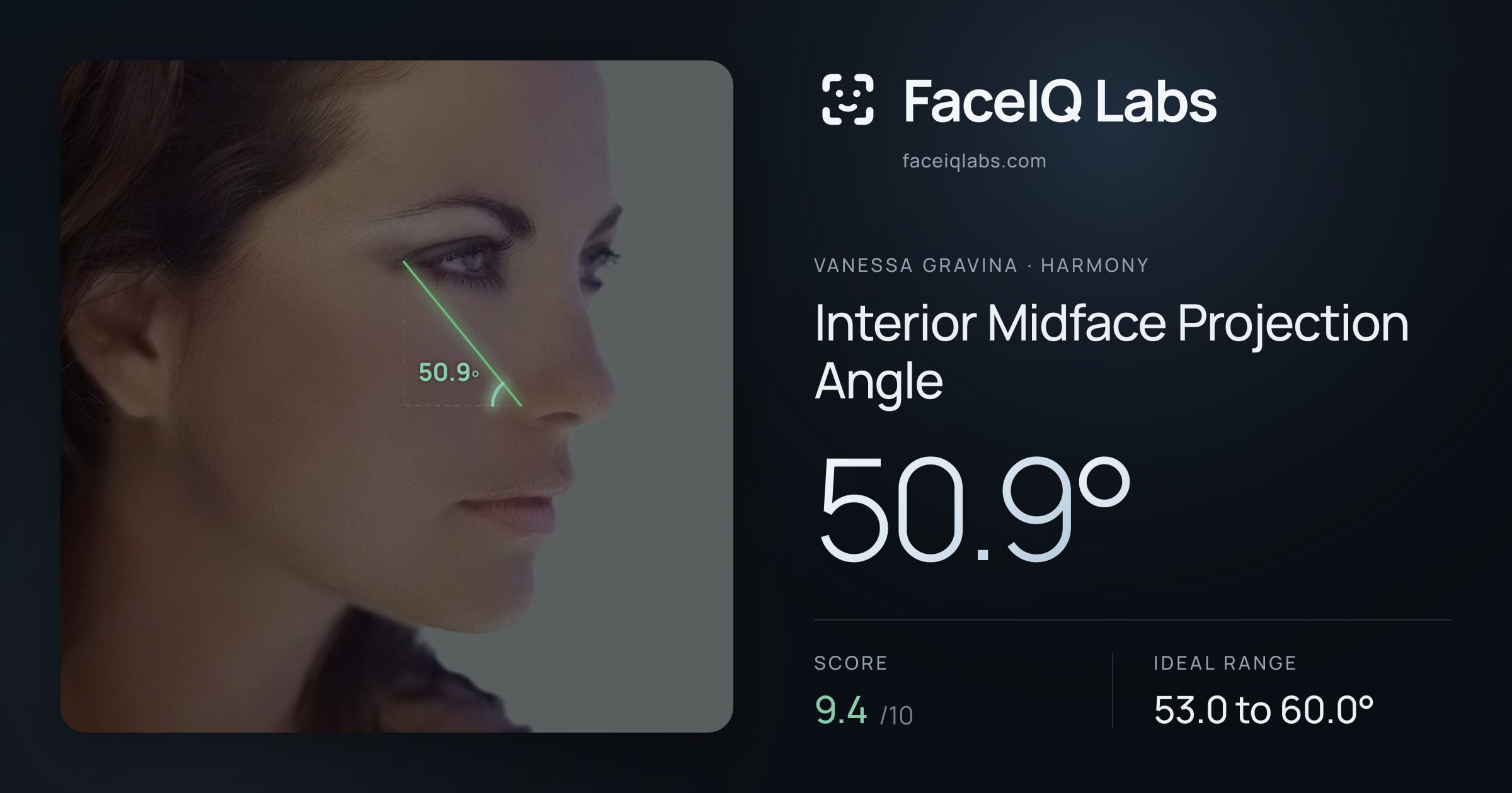 Vanessa Gravina Interior Midface Projection Angle: 50.9°, drawn on the photo