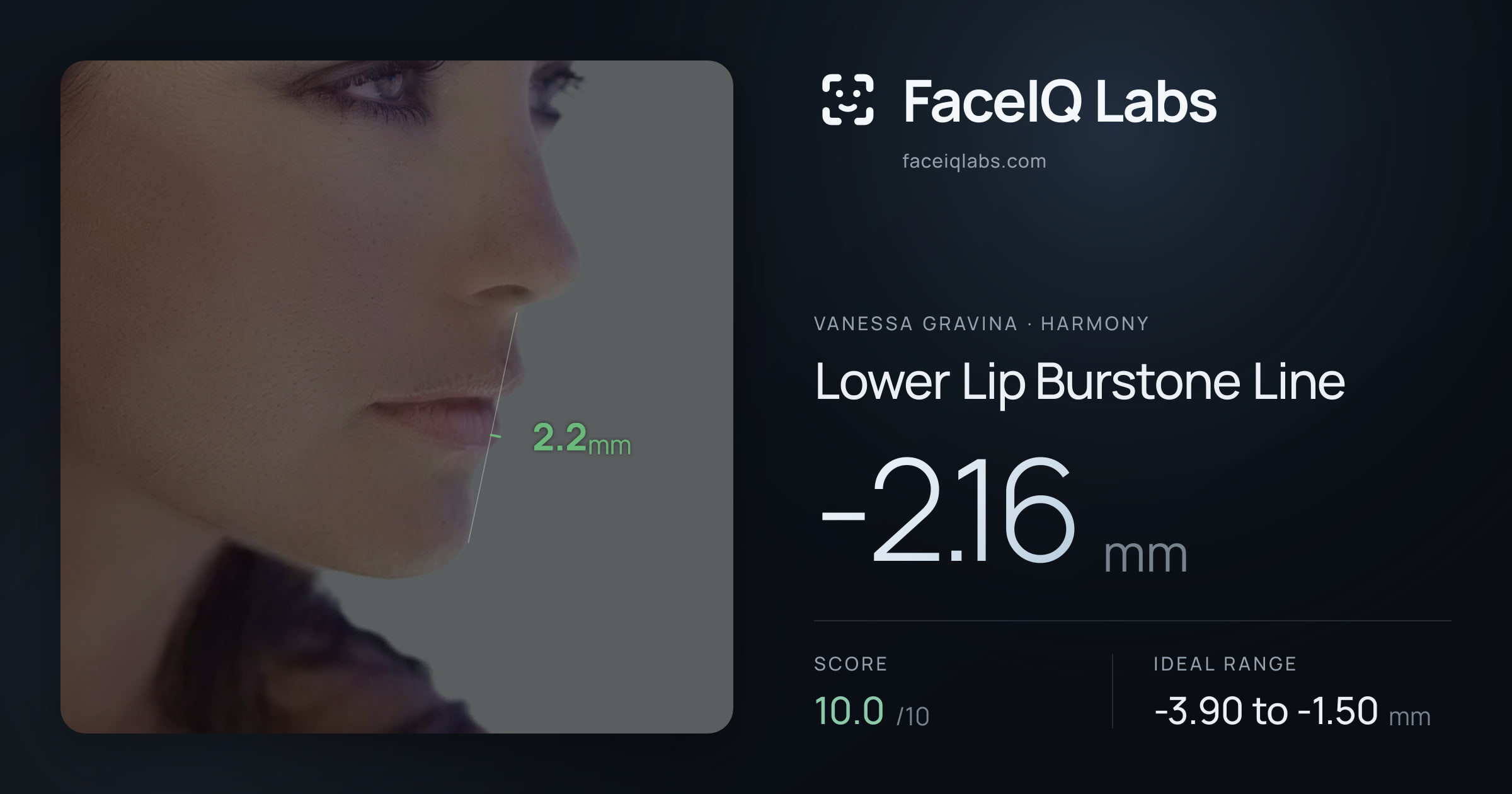 Vanessa Gravina Lower Lip Burstone Line: -2.16mm, drawn on the photo