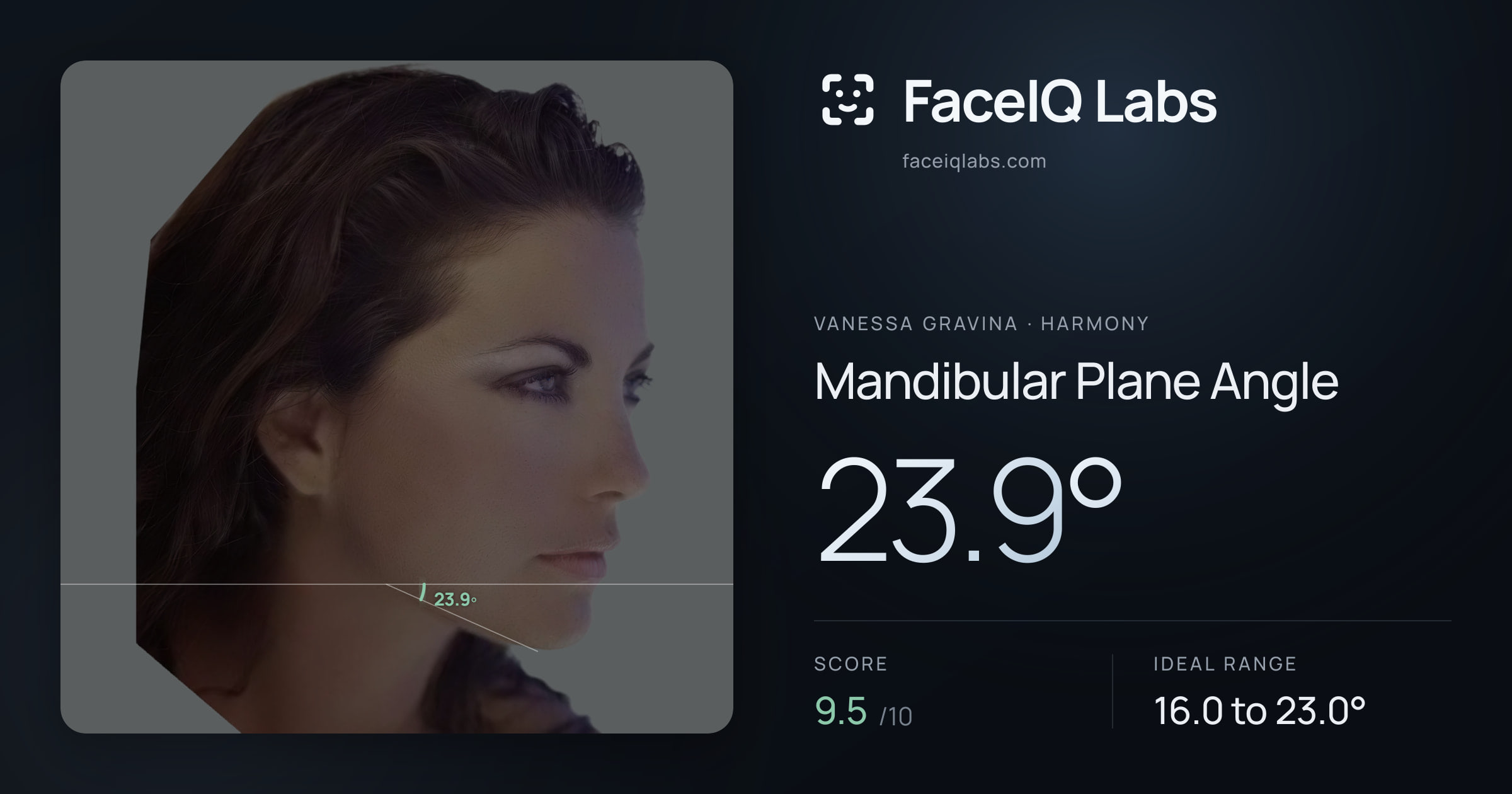 Vanessa Gravina Mandibular Plane Angle: 23.9°, drawn on the photo