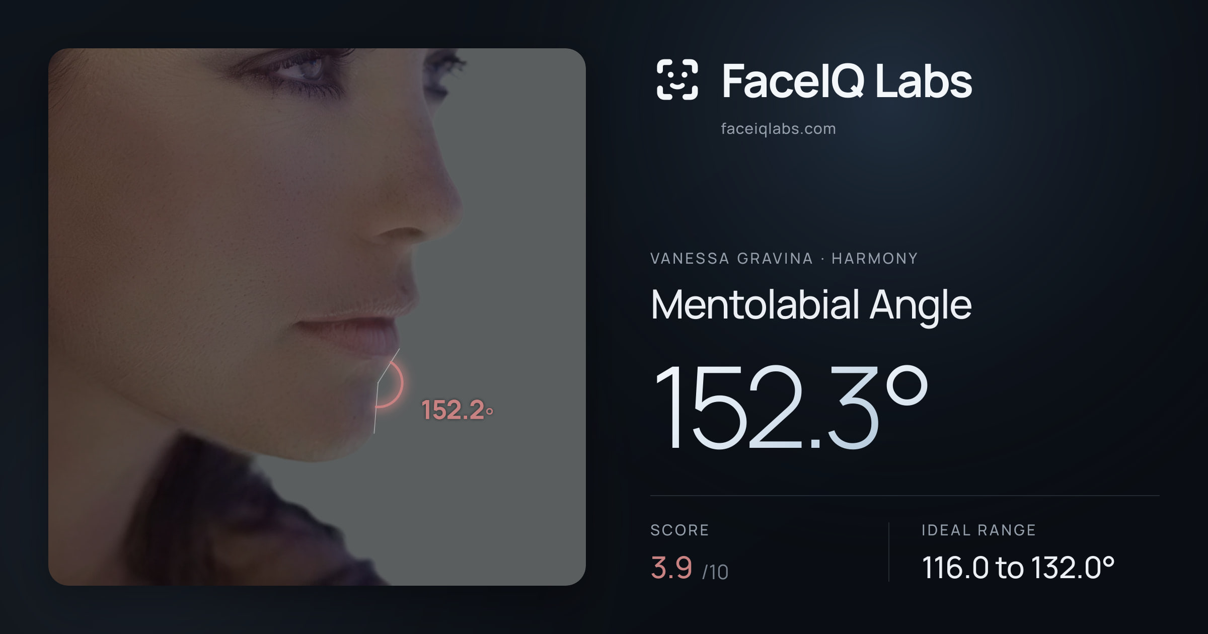 Vanessa Gravina Mentolabial Angle: 152.3°, drawn on the photo