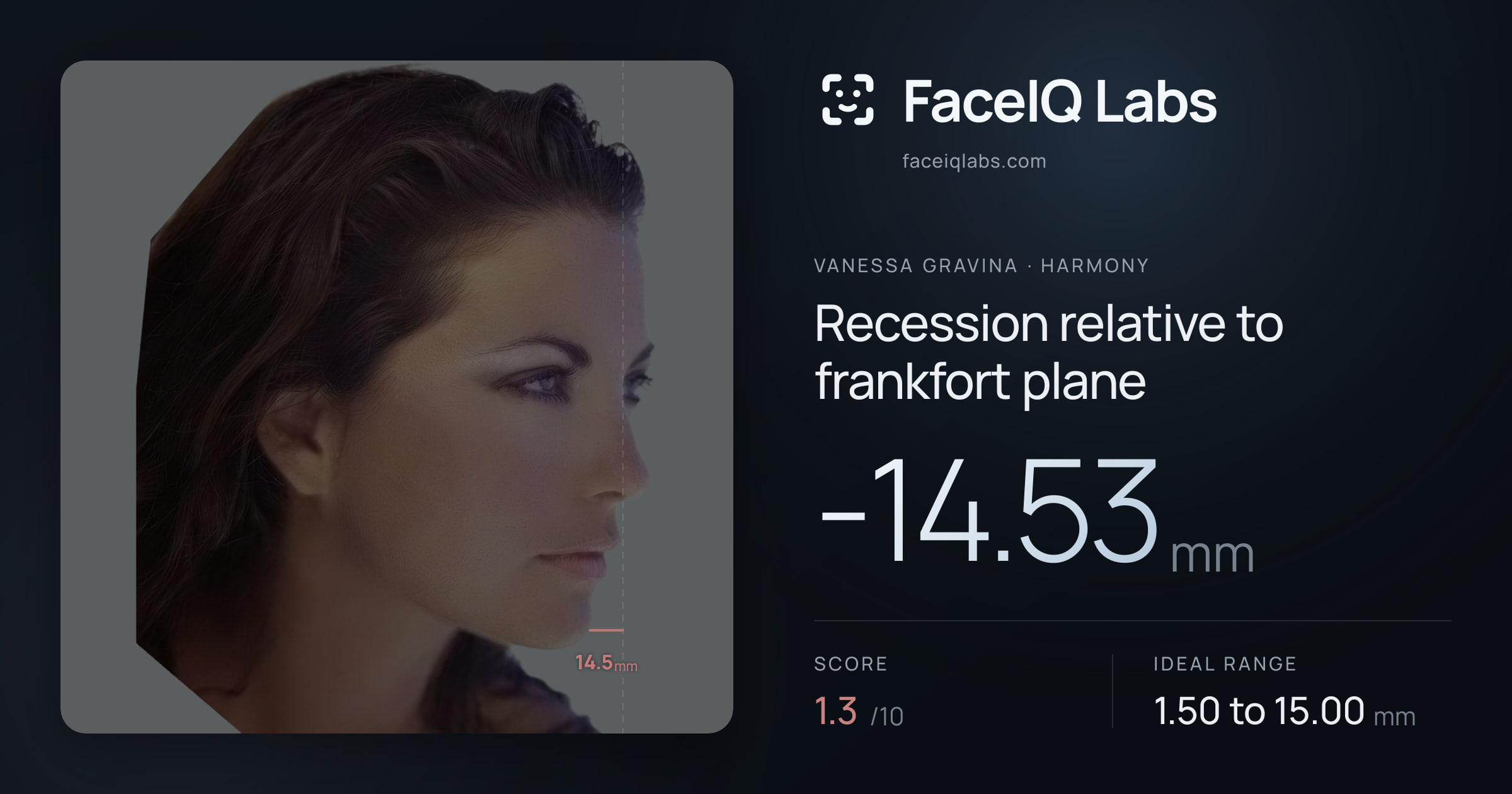 Vanessa Gravina Recession relative to frankfort plane: -14.53mm, drawn on the photo