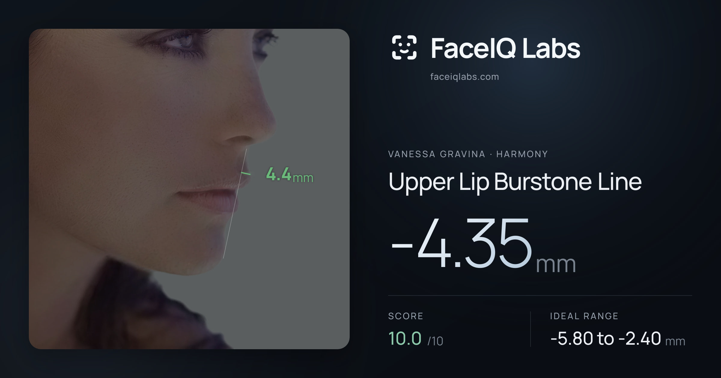 Vanessa Gravina Upper Lip Burstone Line: -4.35mm, drawn on the photo
