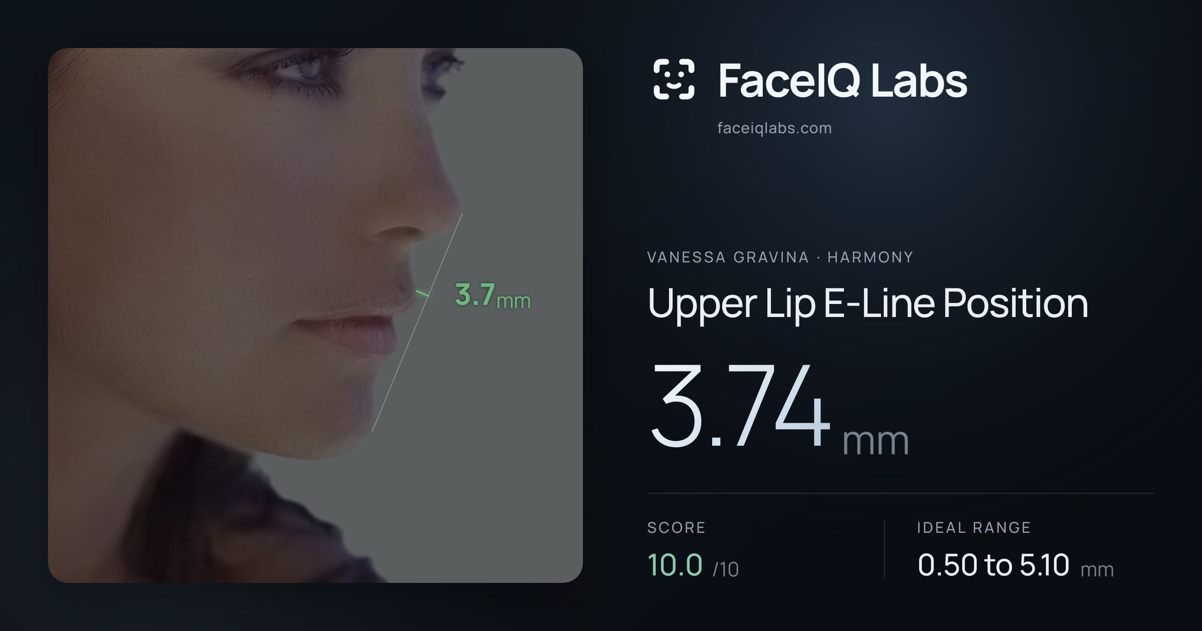 Vanessa Gravina Upper Lip E-Line Position: 3.74mm, drawn on the photo