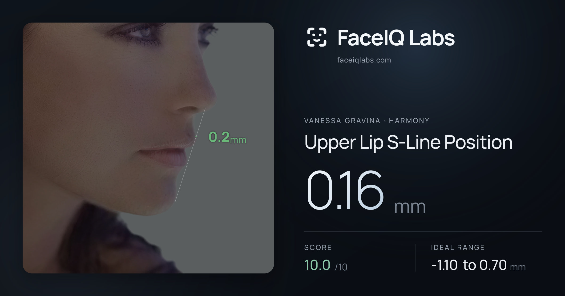 Vanessa Gravina Upper Lip S-Line Position: 0.16mm, drawn on the photo