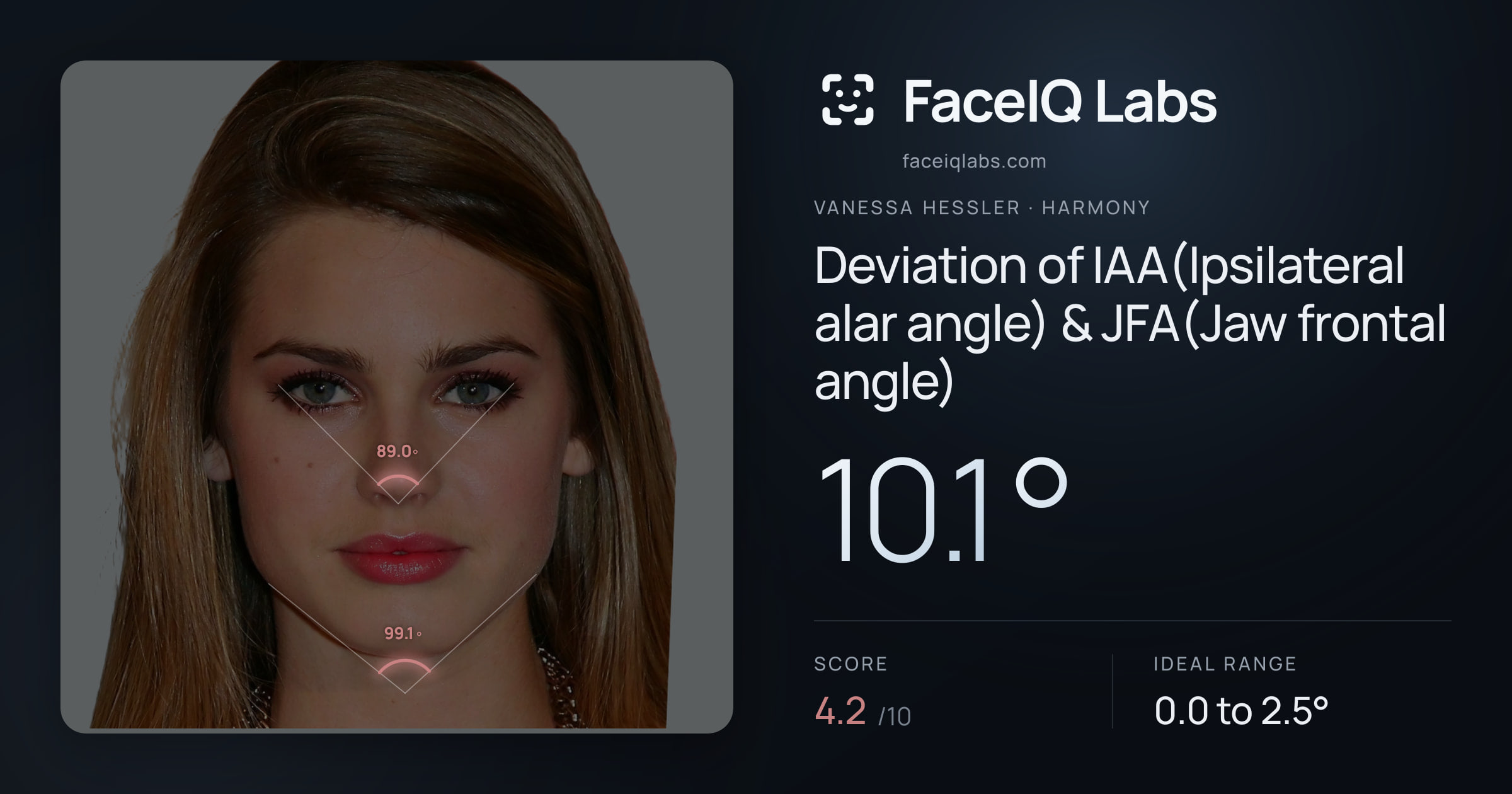 Vanessa Hessler Deviation of IAA(Ipsilateral alar angle) & JFA(Jaw frontal angle): 10.1°, drawn on the photo