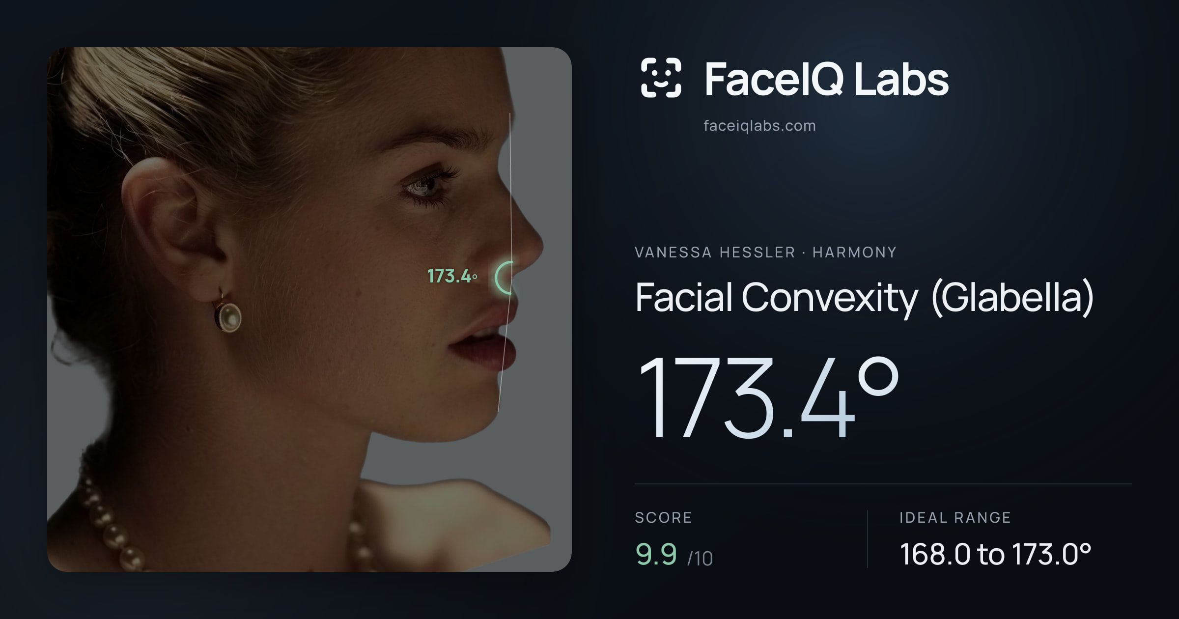 Vanessa Hessler Facial Convexity (Glabella): 173.4°, drawn on the photo